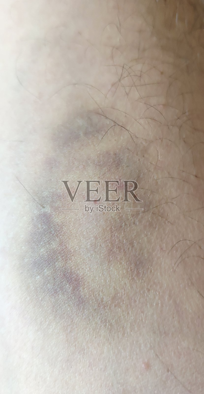 男人手臂上瘀伤的特写照片摄影图片