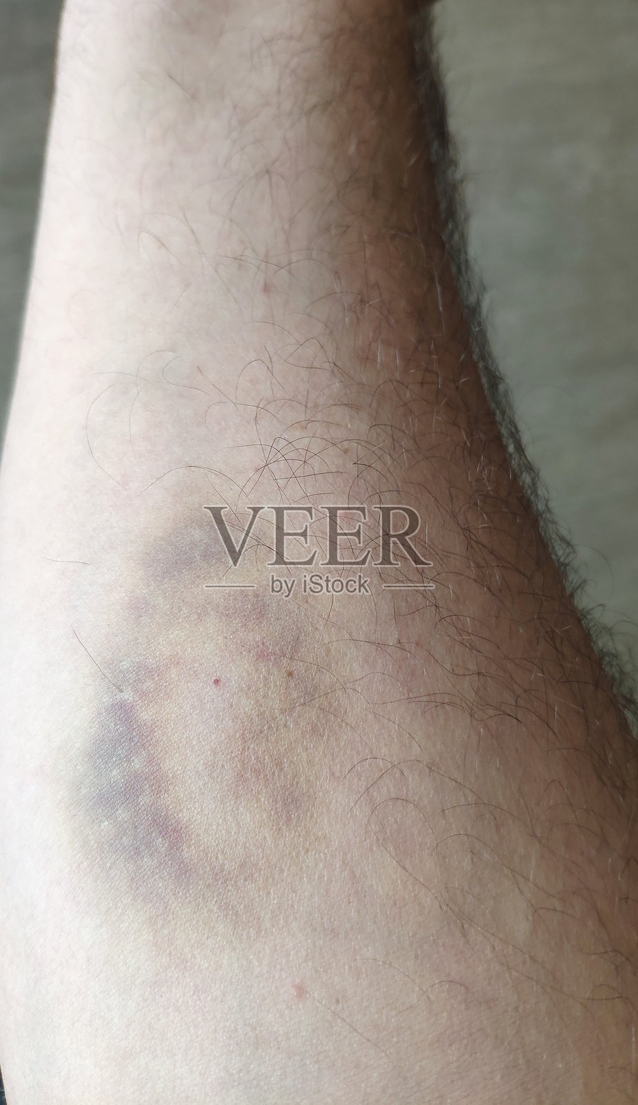 男人手臂上瘀伤的特写照片摄影图片