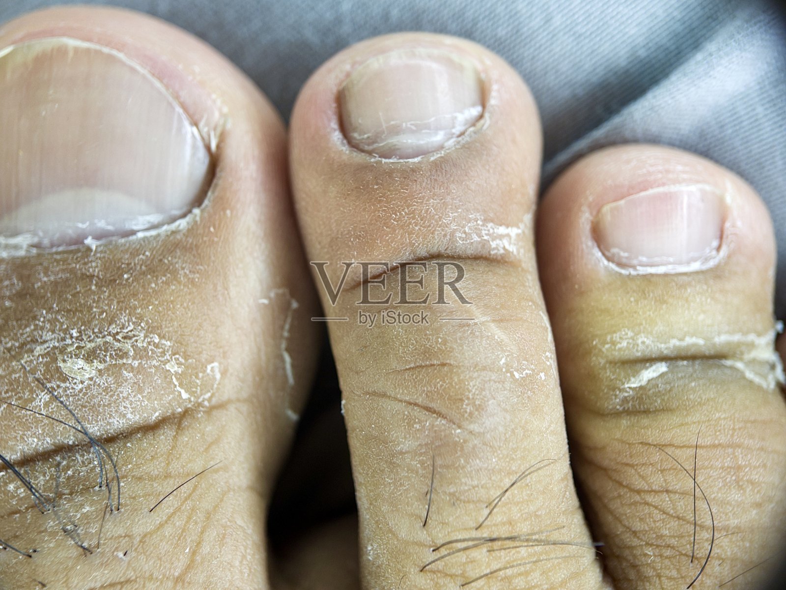 详细展示了脚趾特写,皮肤干燥脱皮,有明显污垢,显示出足癣的迹象。照片摄影图片