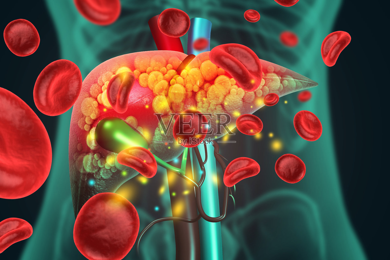 肝脏损伤,例如脂肪肝、肝纤维化、肝硬化和肝癌。三维插画照片摄影图片