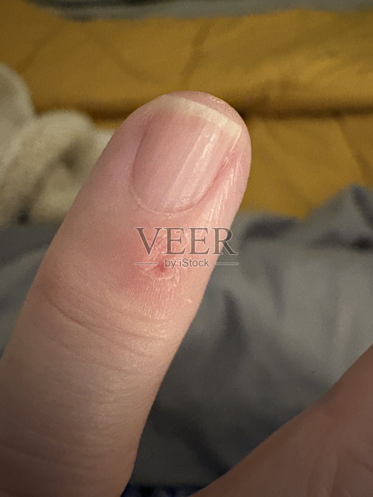 雷诺氏现象数字发作的特写照片摄影图片