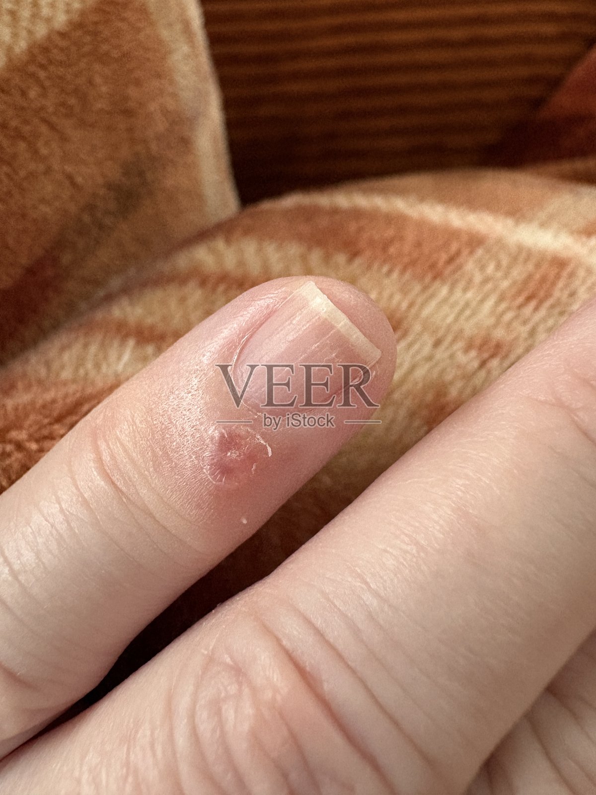 雷诺现象手指发作特写照片摄影图片