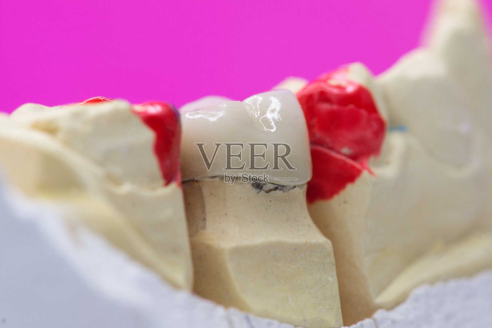 金属陶瓷牙冠试戴照片摄影图片