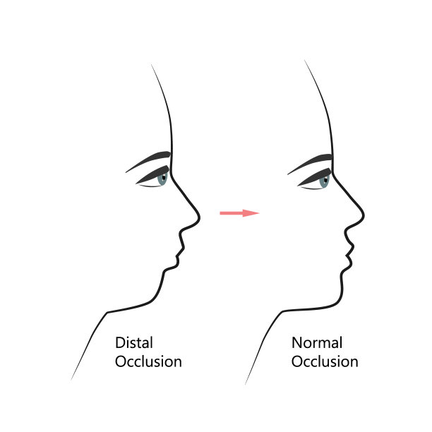 正畸治疗前后远端咬合轮廓。有错咬合的人,下颚往后推,用牙套矫正咬合。矢量图图片 正畸治疗前后远端咬合轮廓。有错咬合的人,下颚往后推,用牙套矫正咬合。矢量图图片下载