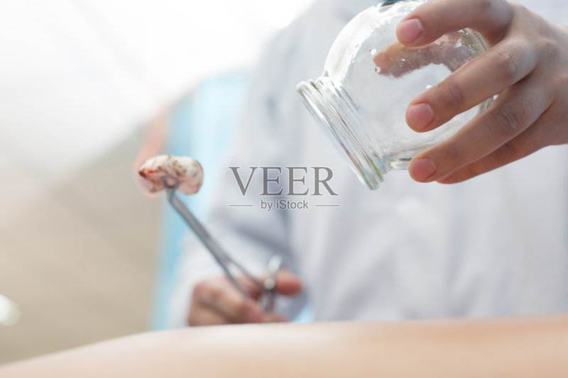 中医拔火罐疗法正版图片素材