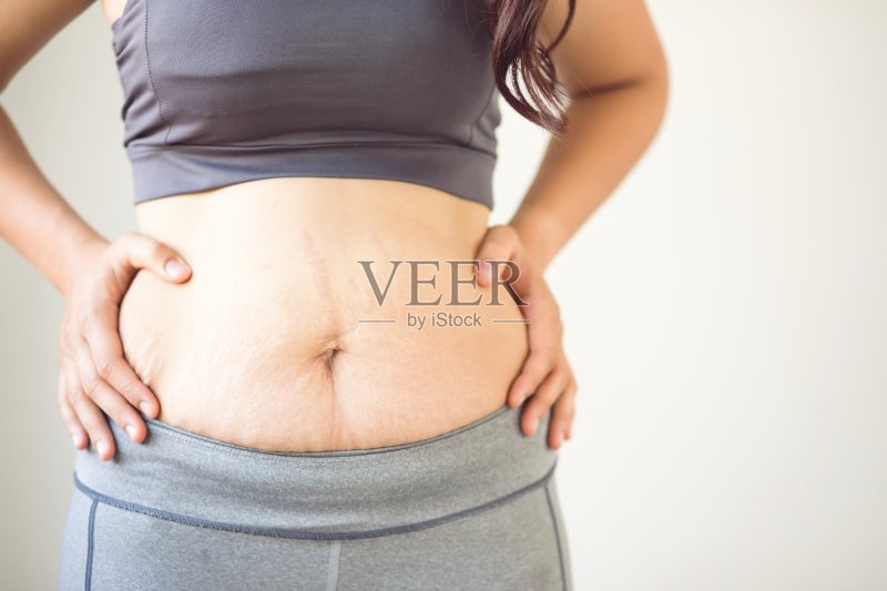 孕妇腹部皮肤造成条纹状脂肪和疤痕正版图片素材