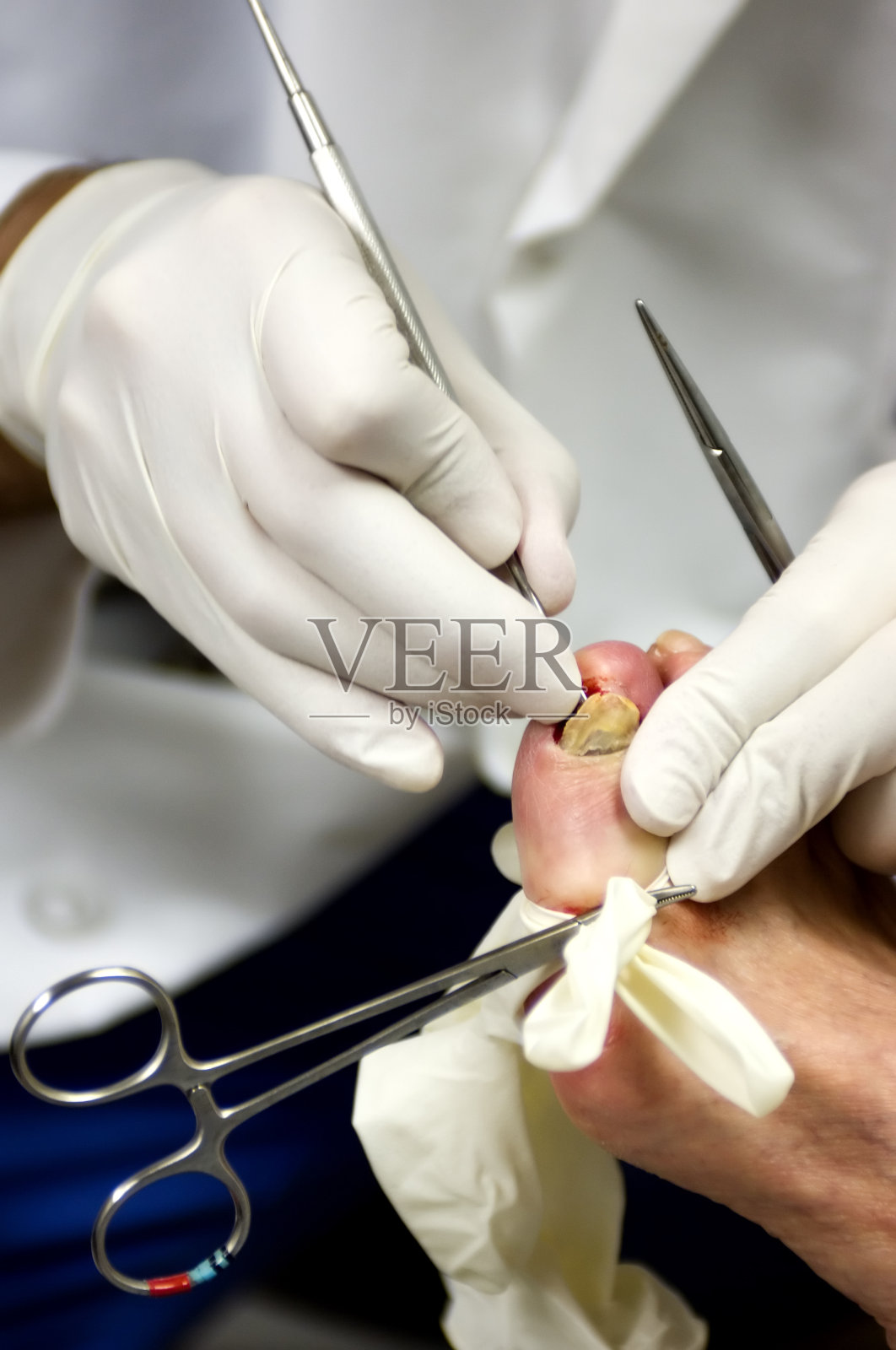 足病手术1照片摄影图片