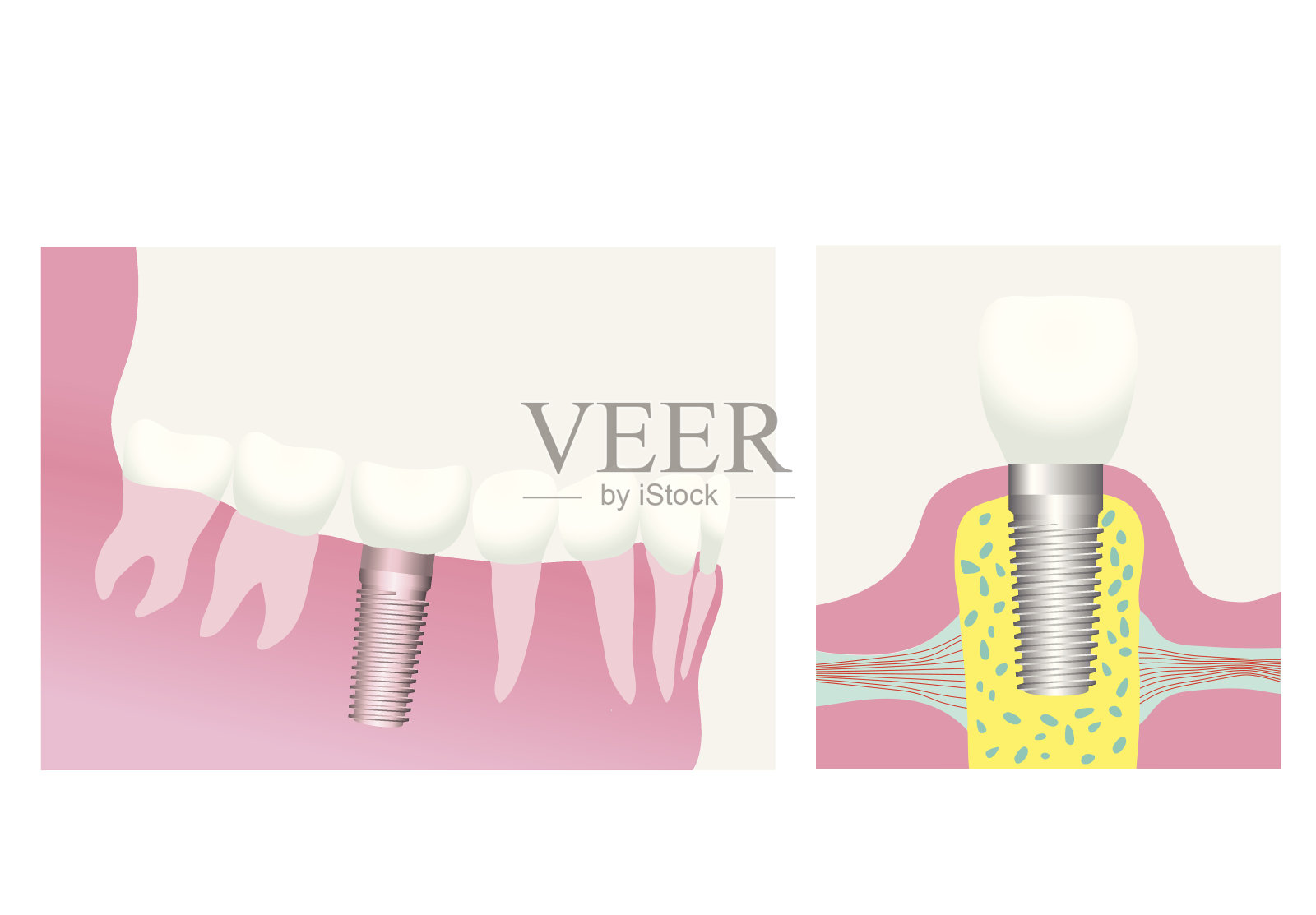 牙科植体插画图片素材