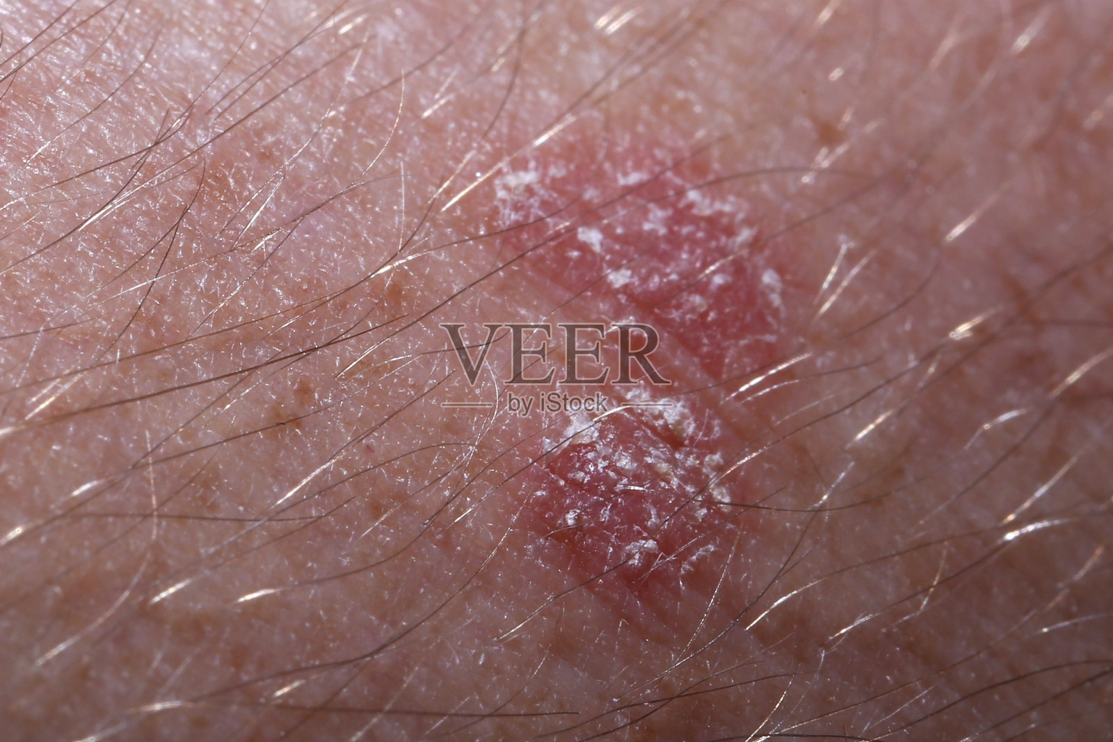 皮疹照片摄影图片