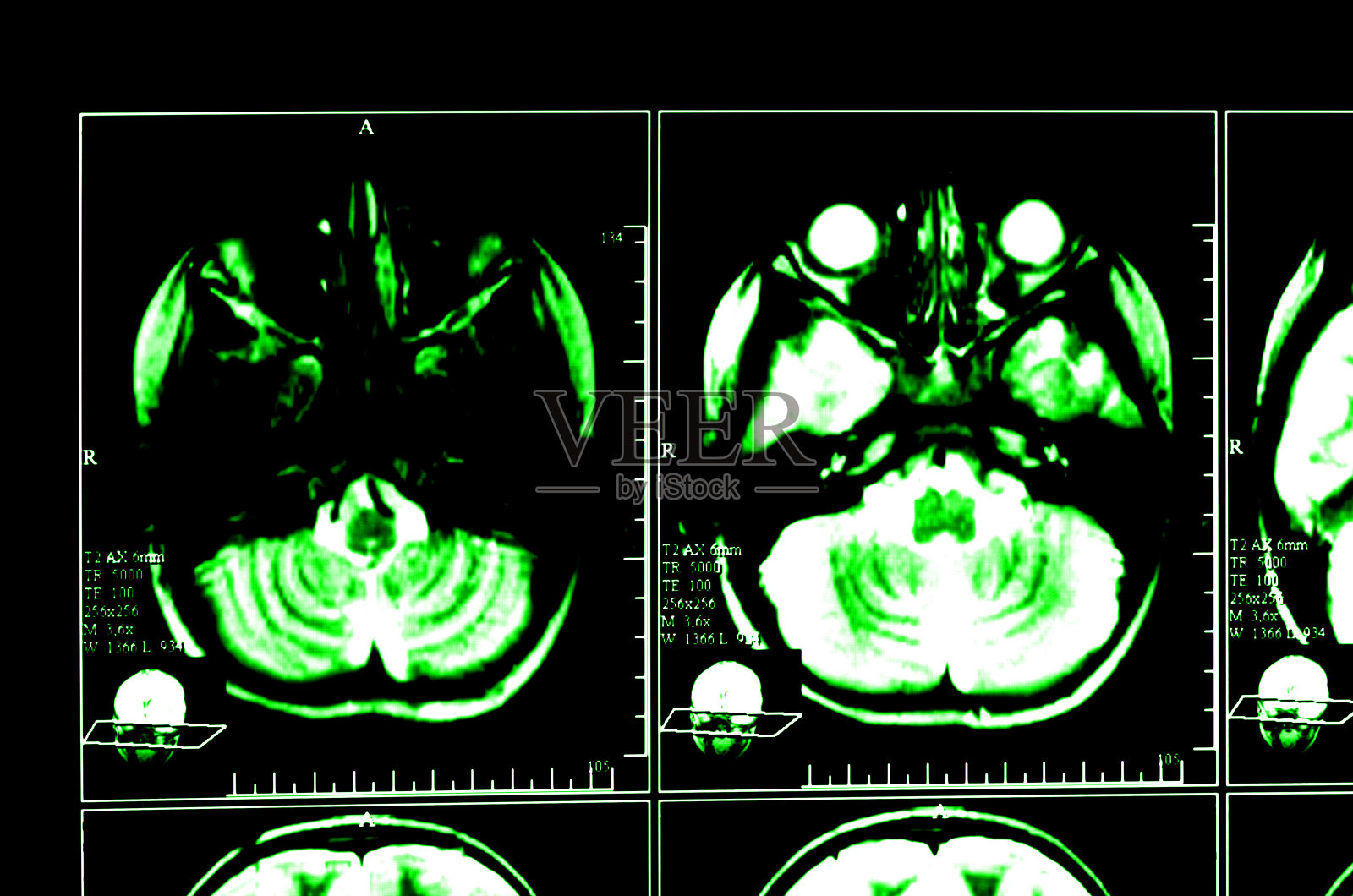 脑部计算机断层扫描的x射线图像照片摄影图片