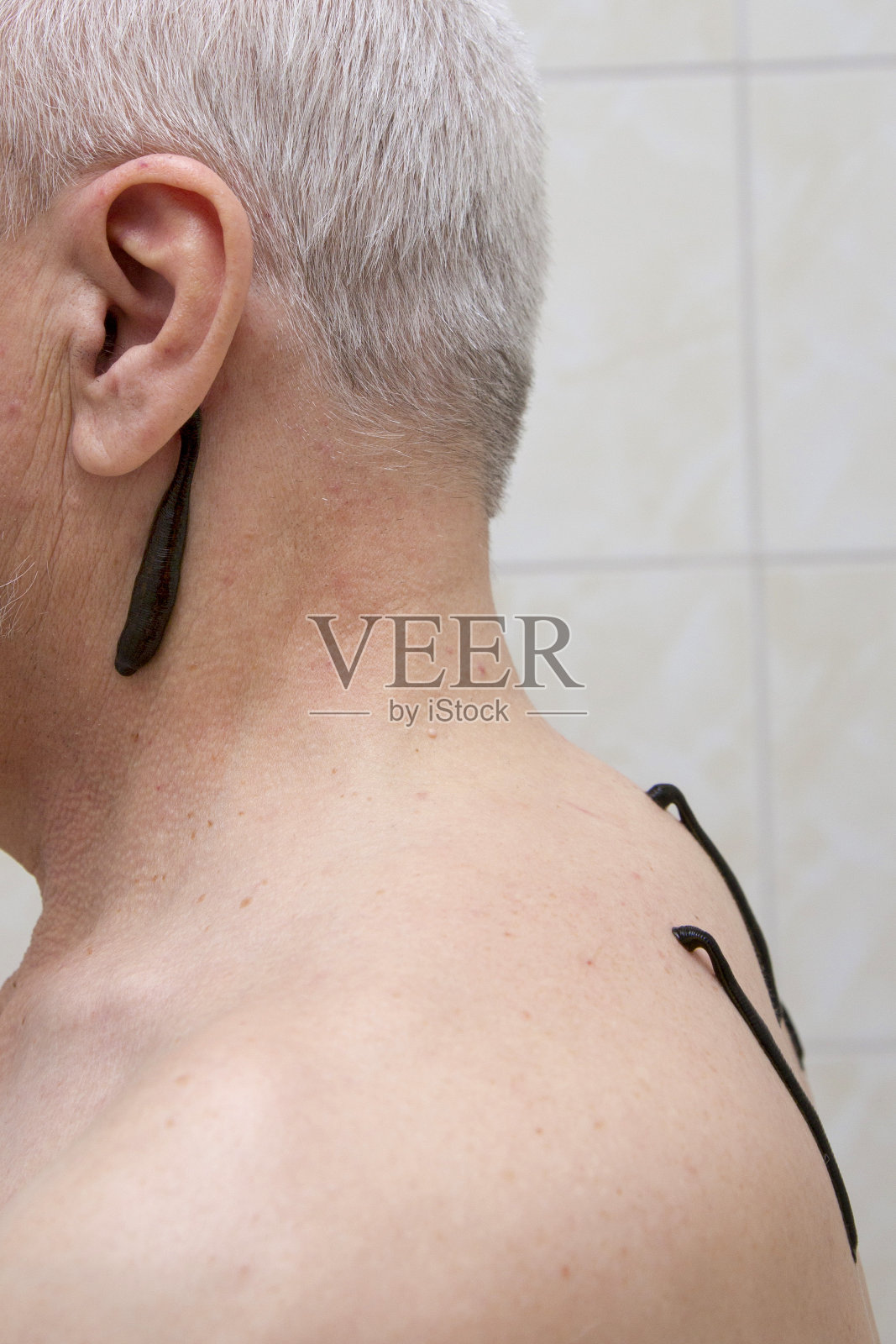 水蛭疗法照片摄影图片