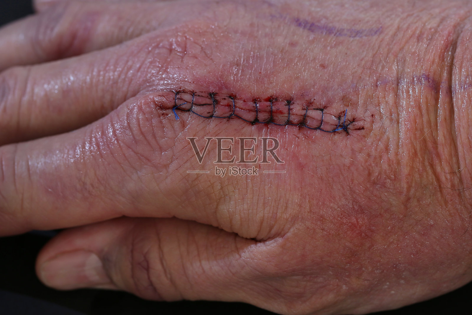 医学的伤口照片摄影图片