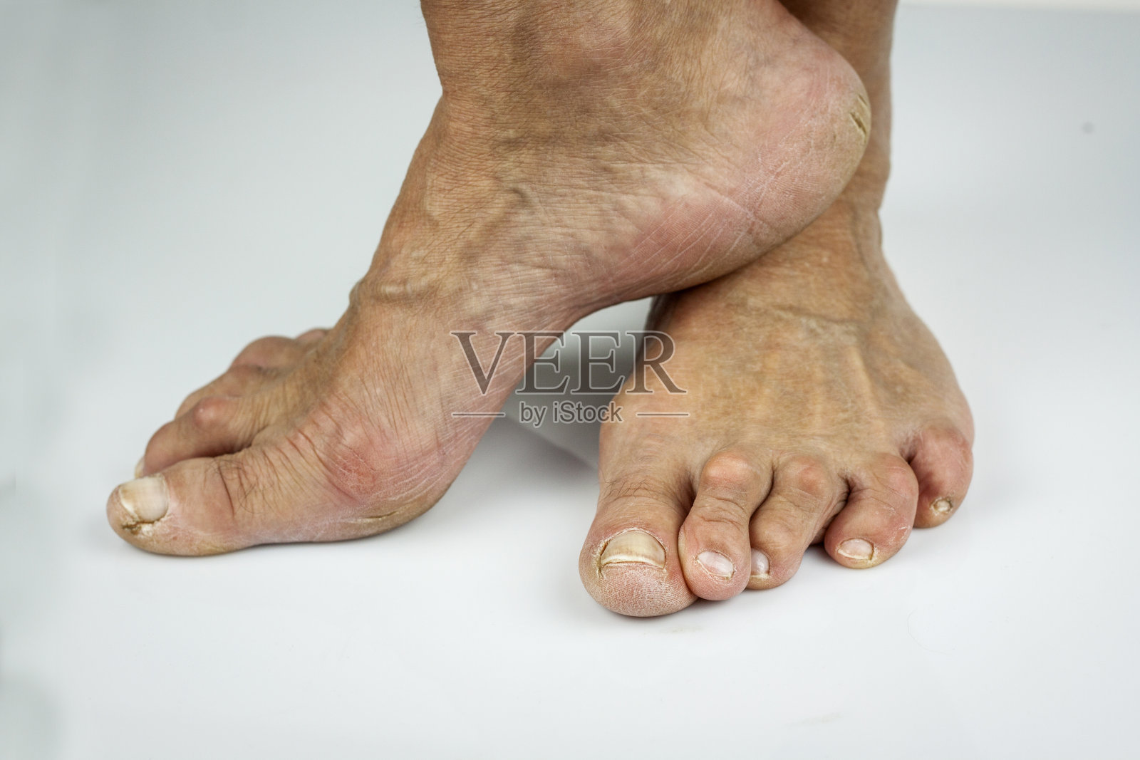 类风湿性关节炎照片摄影图片