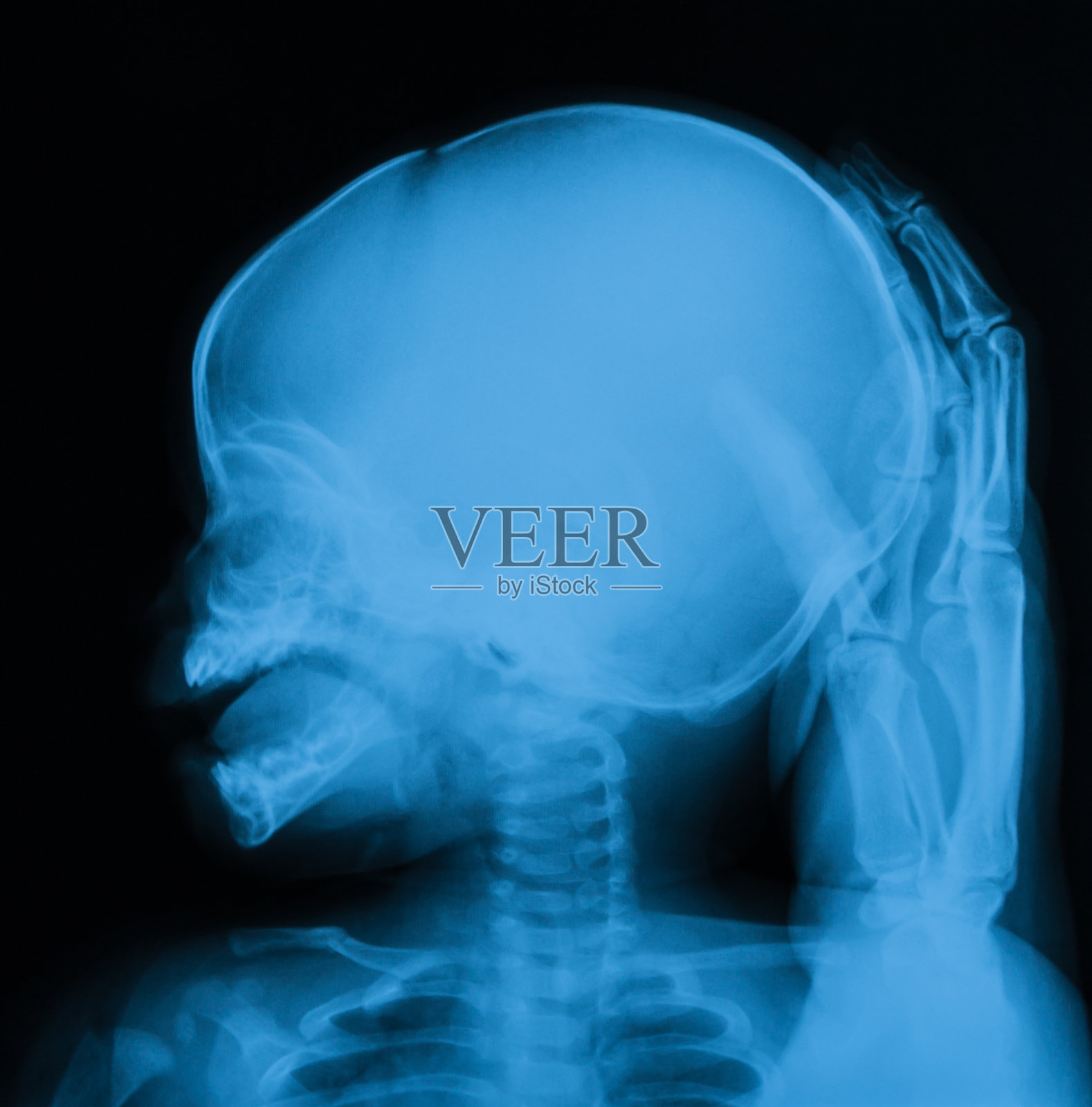 哭闹婴儿的头颅x光片，侧视图。照片摄影图片