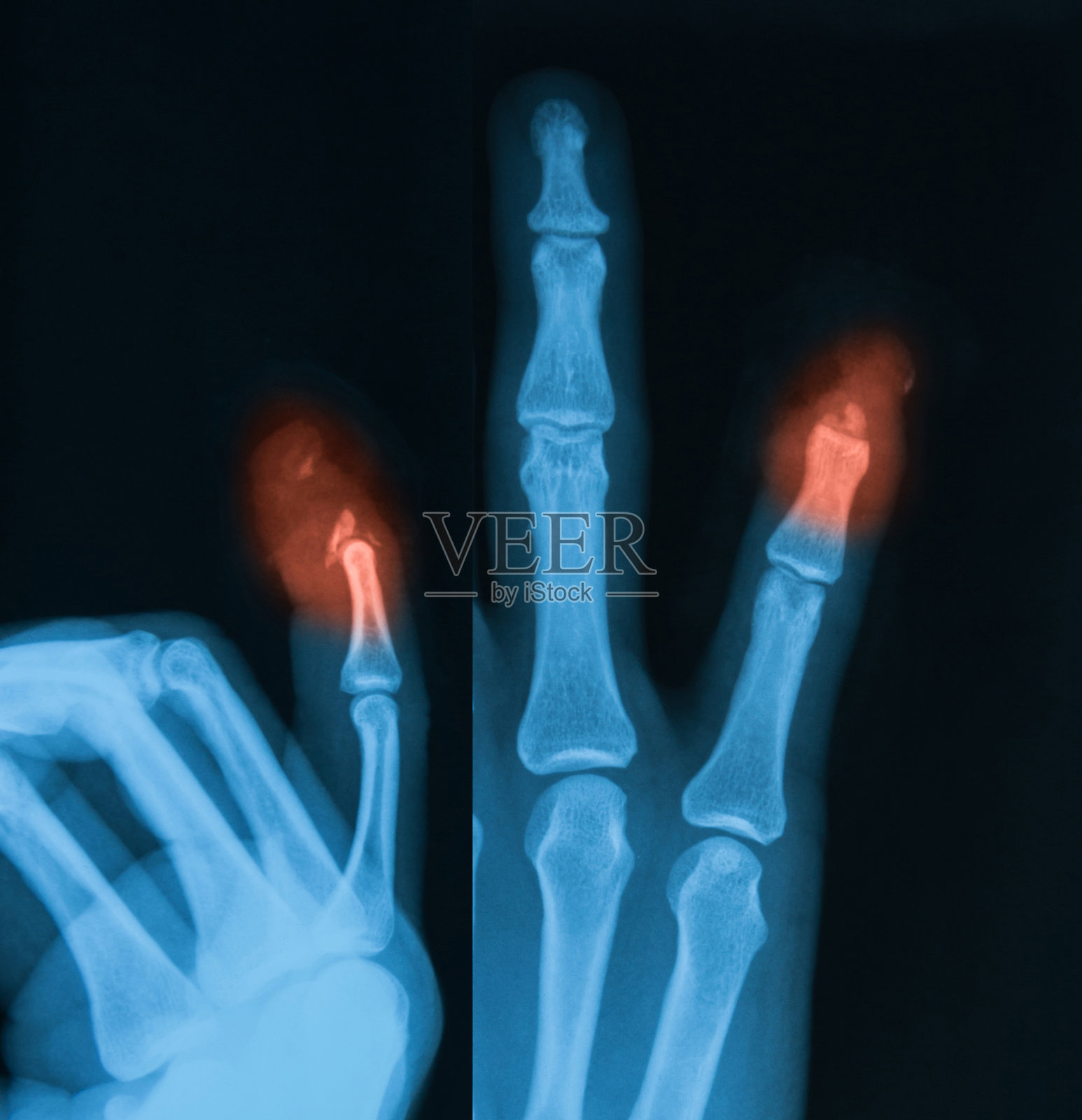 手、PA、侧位x线图像。照片摄影图片