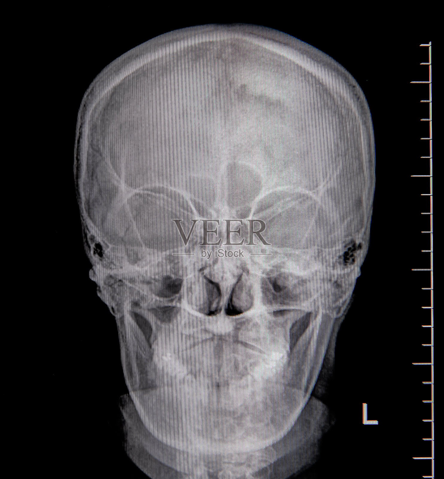 颅骨的x光照片照片摄影图片