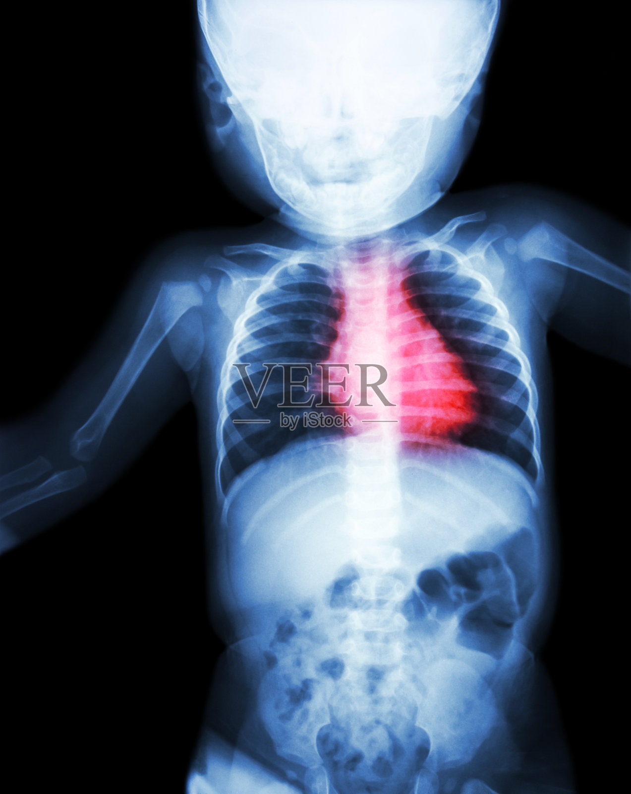 为患有心脏病的儿童拍摄全身x光片照片摄影图片