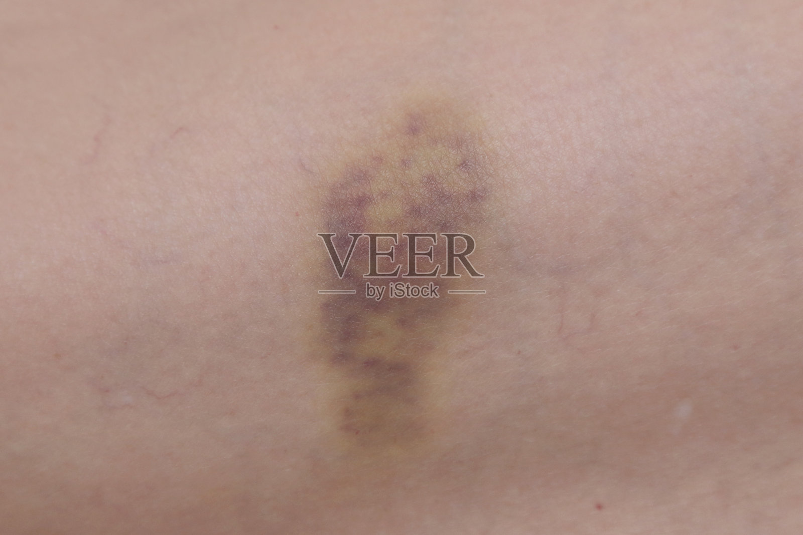 皮肤上的淤青照片摄影图片