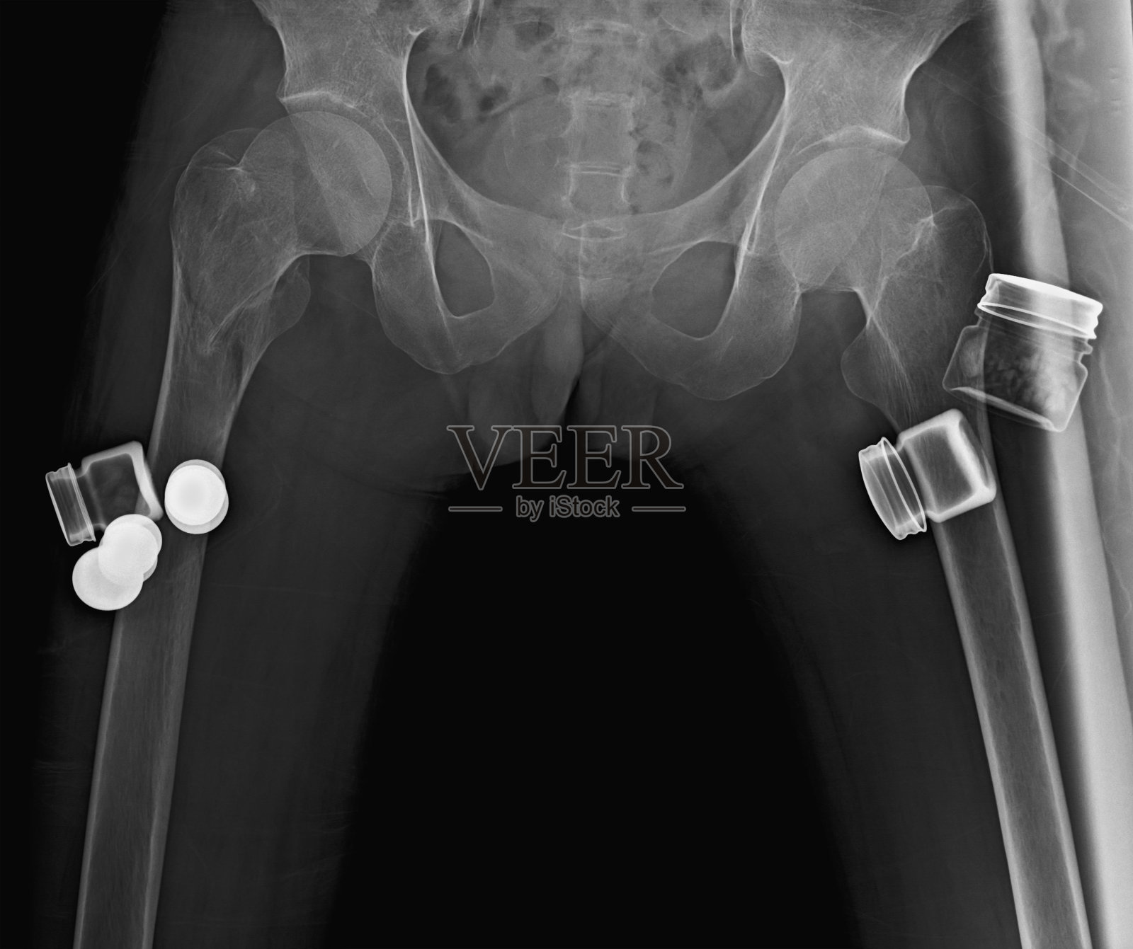 臀部和药瓶的x光图像照片摄影图片