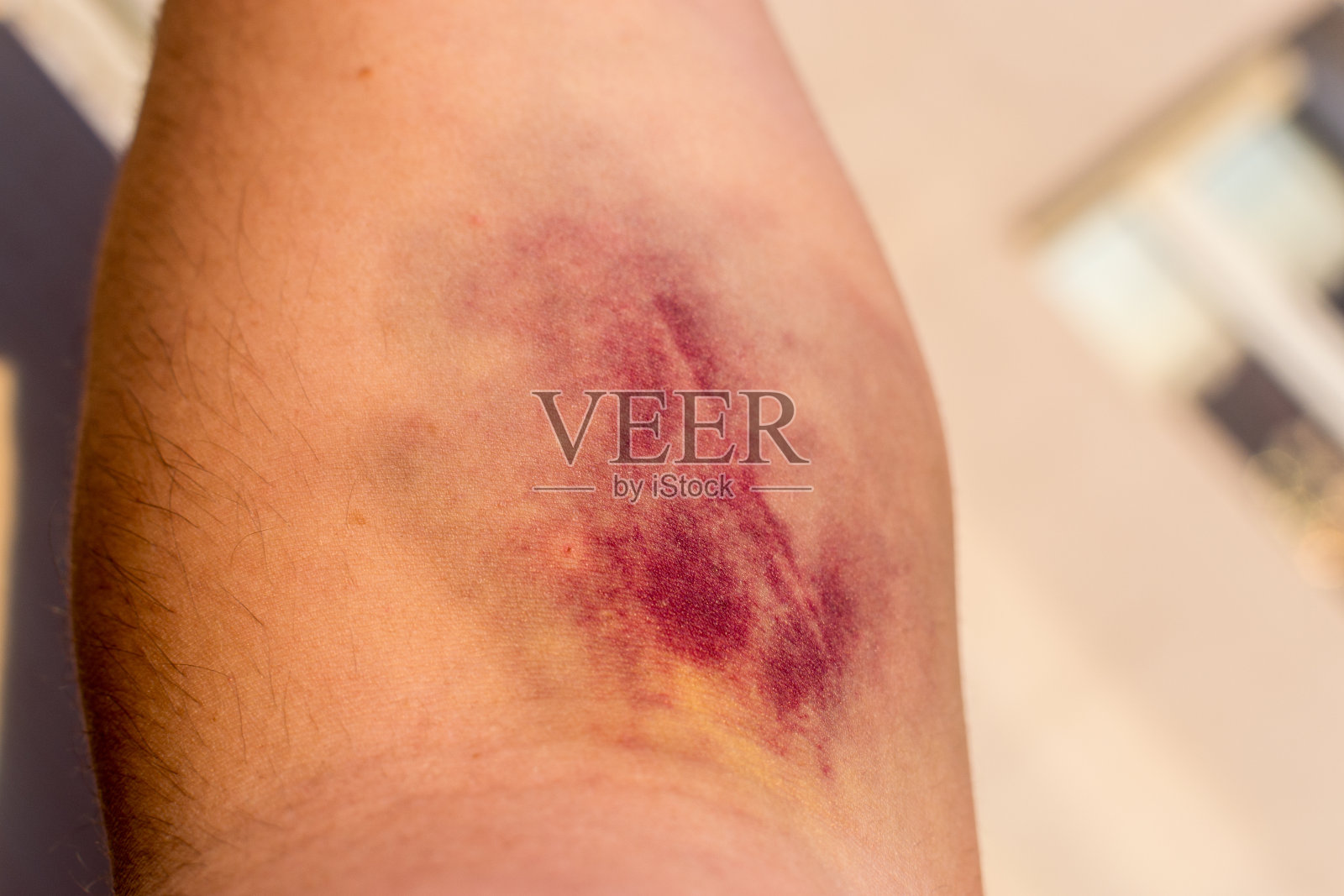 受伤的人的前臂照片摄影图片