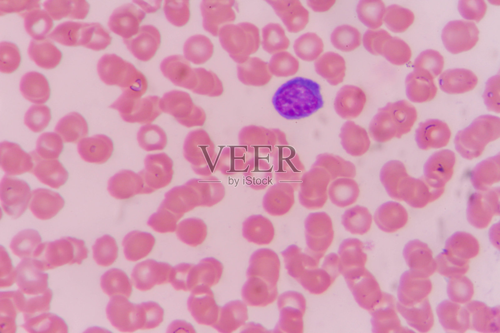 非典型性淋巴细胞照片摄影图片