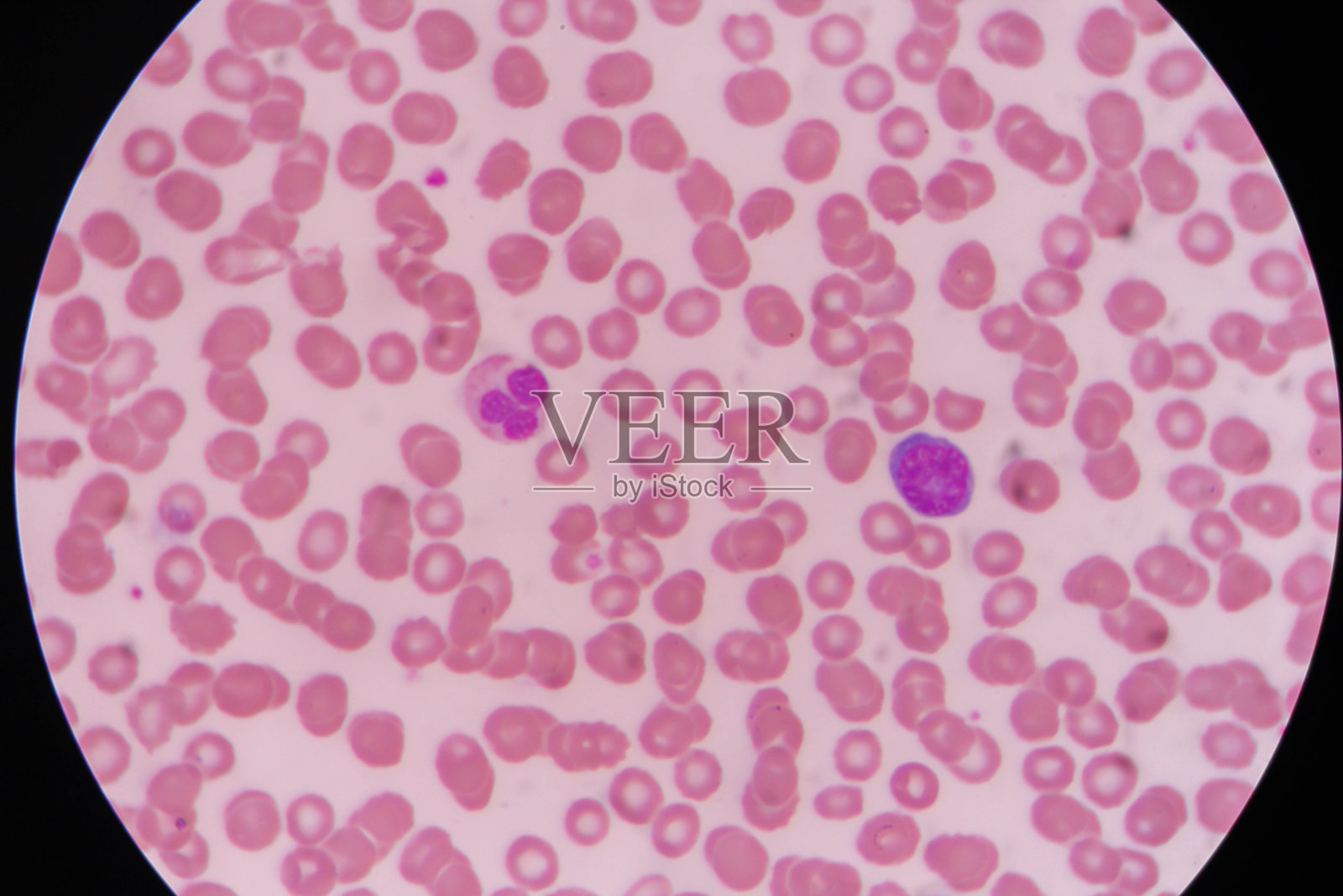非典型性淋巴细胞照片摄影图片