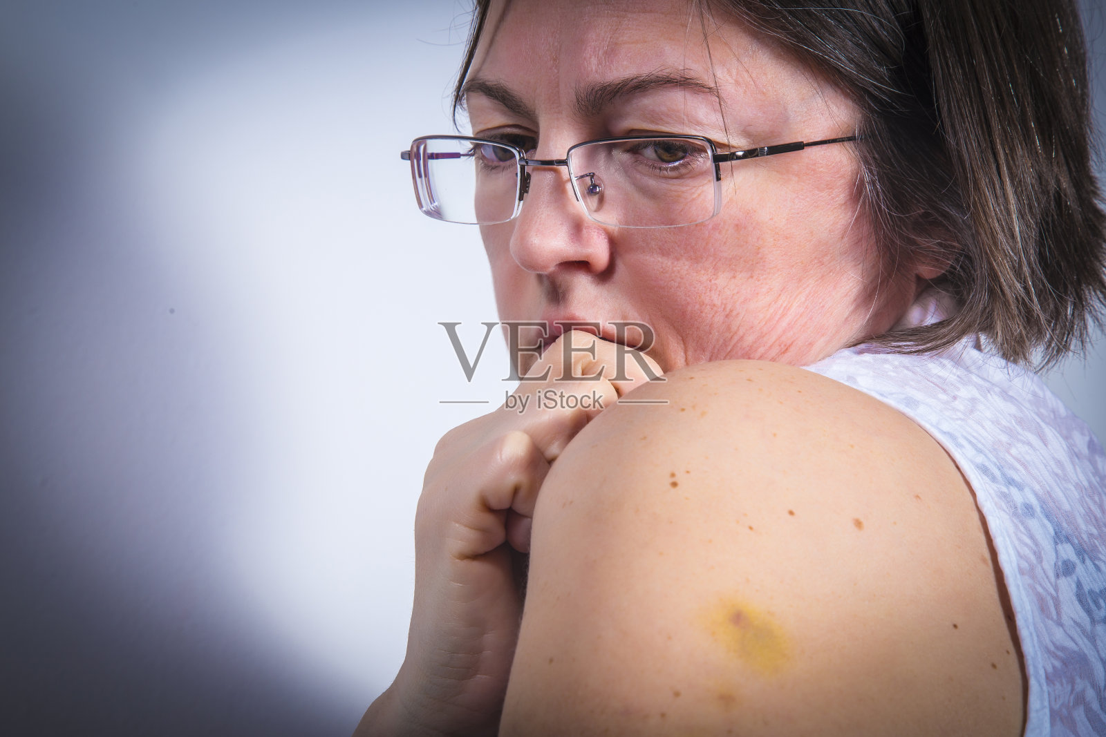 成年患者出现瘀伤照片摄影图片