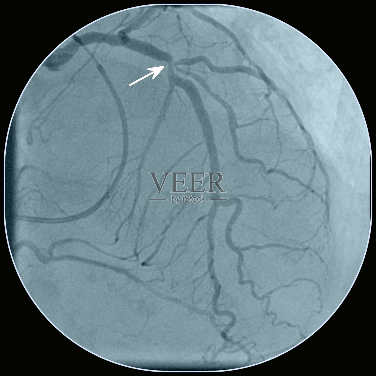冠状动脉狭窄照片摄影图片