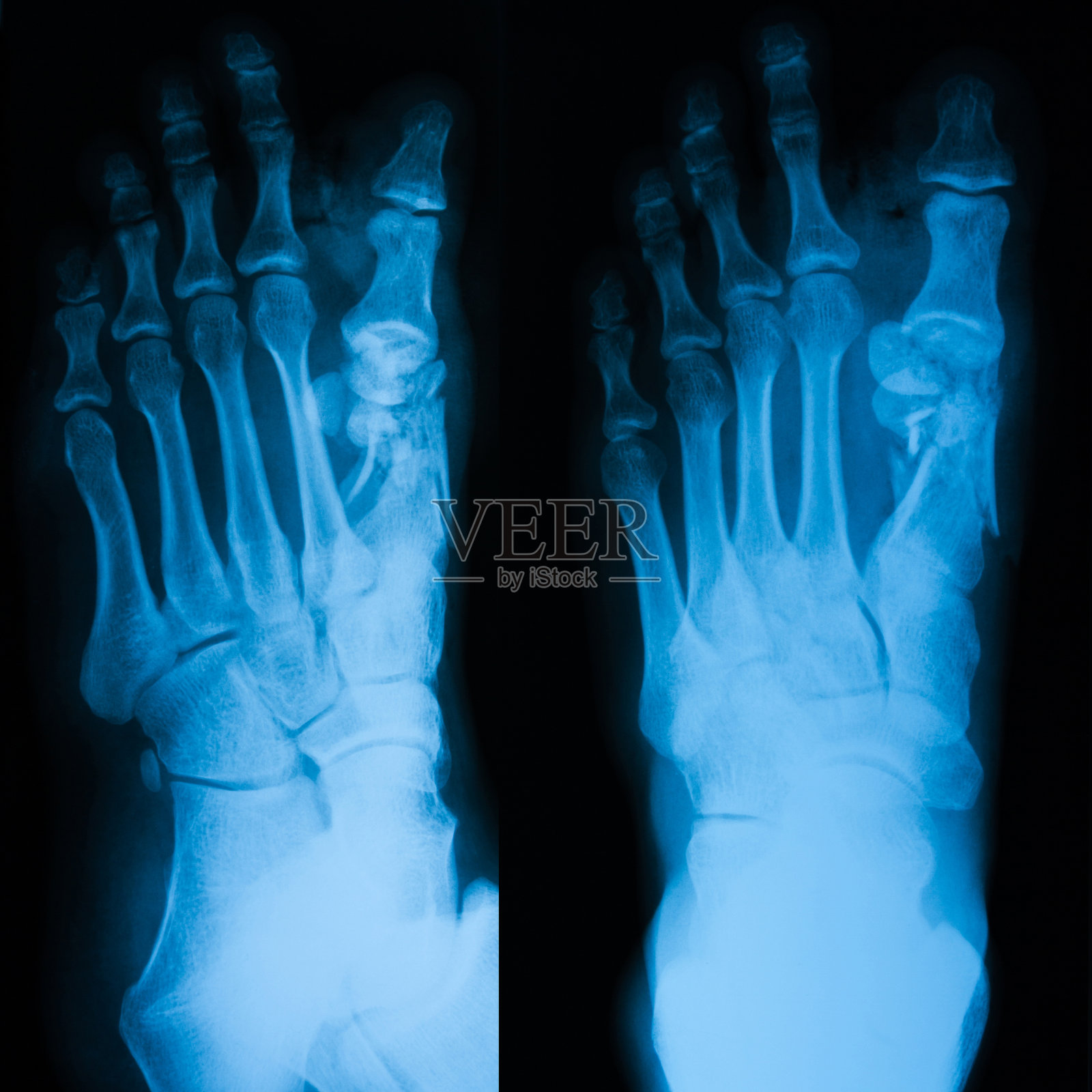 足部、正位和斜位x线图像照片摄影图片