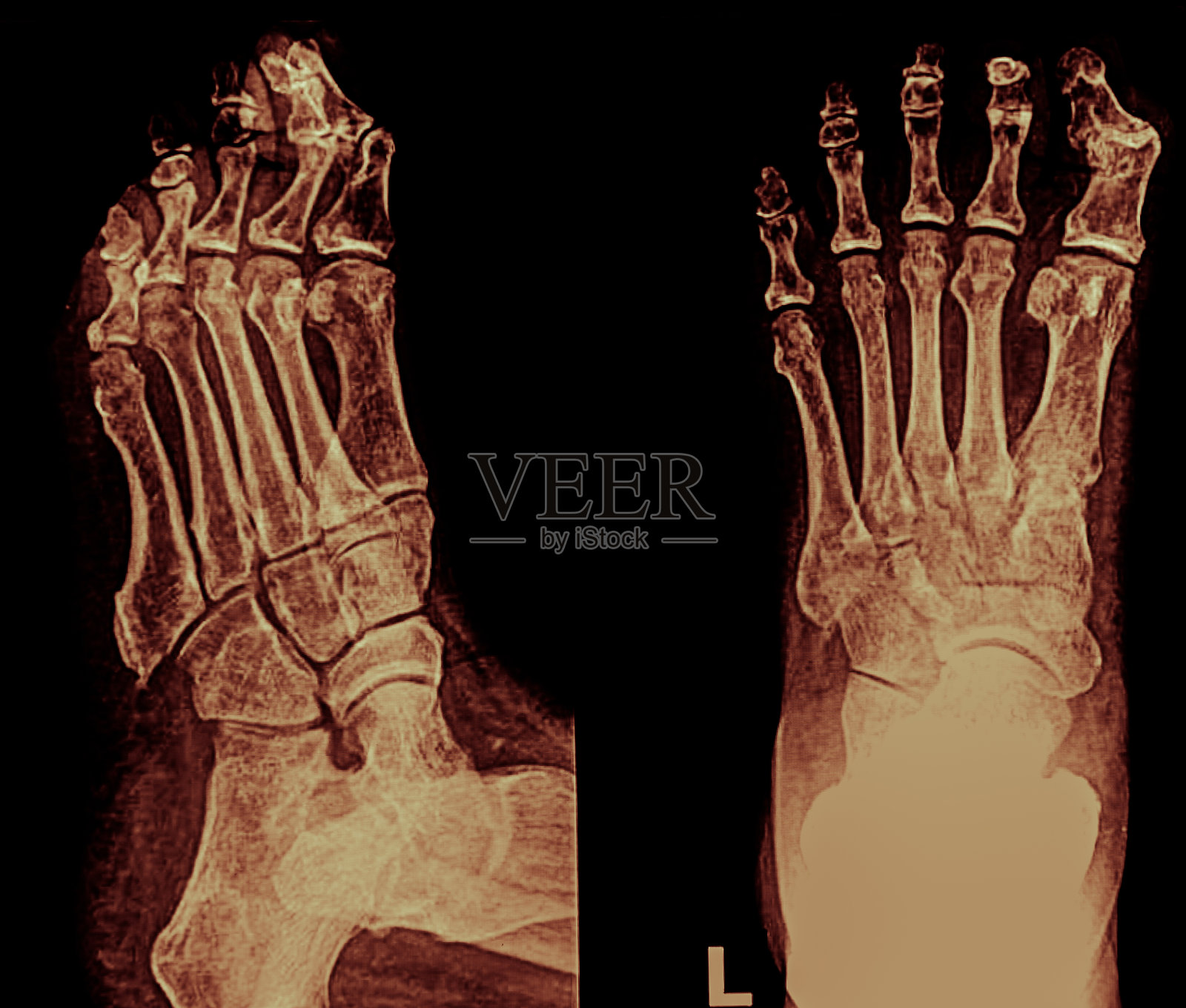 脚x光片，侧视图照片摄影图片
