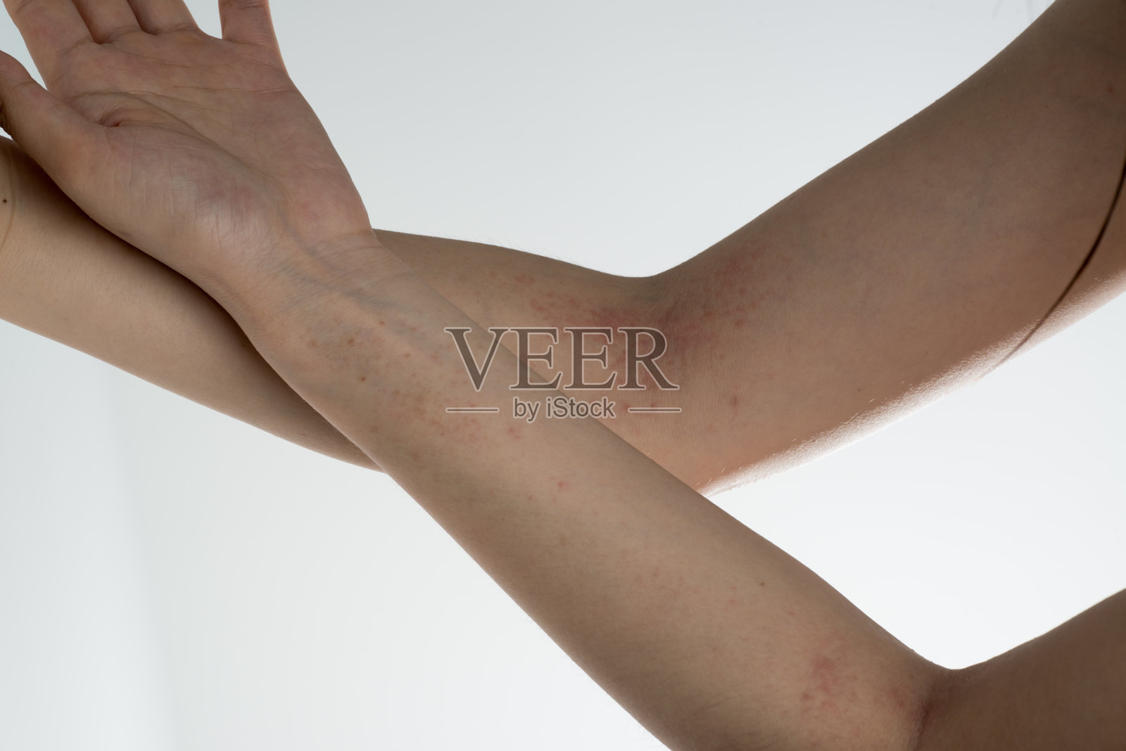 手上有过敏病皮肤照片摄影图片