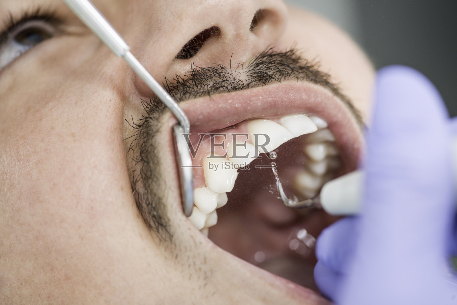 去除菌斑照片摄影图片