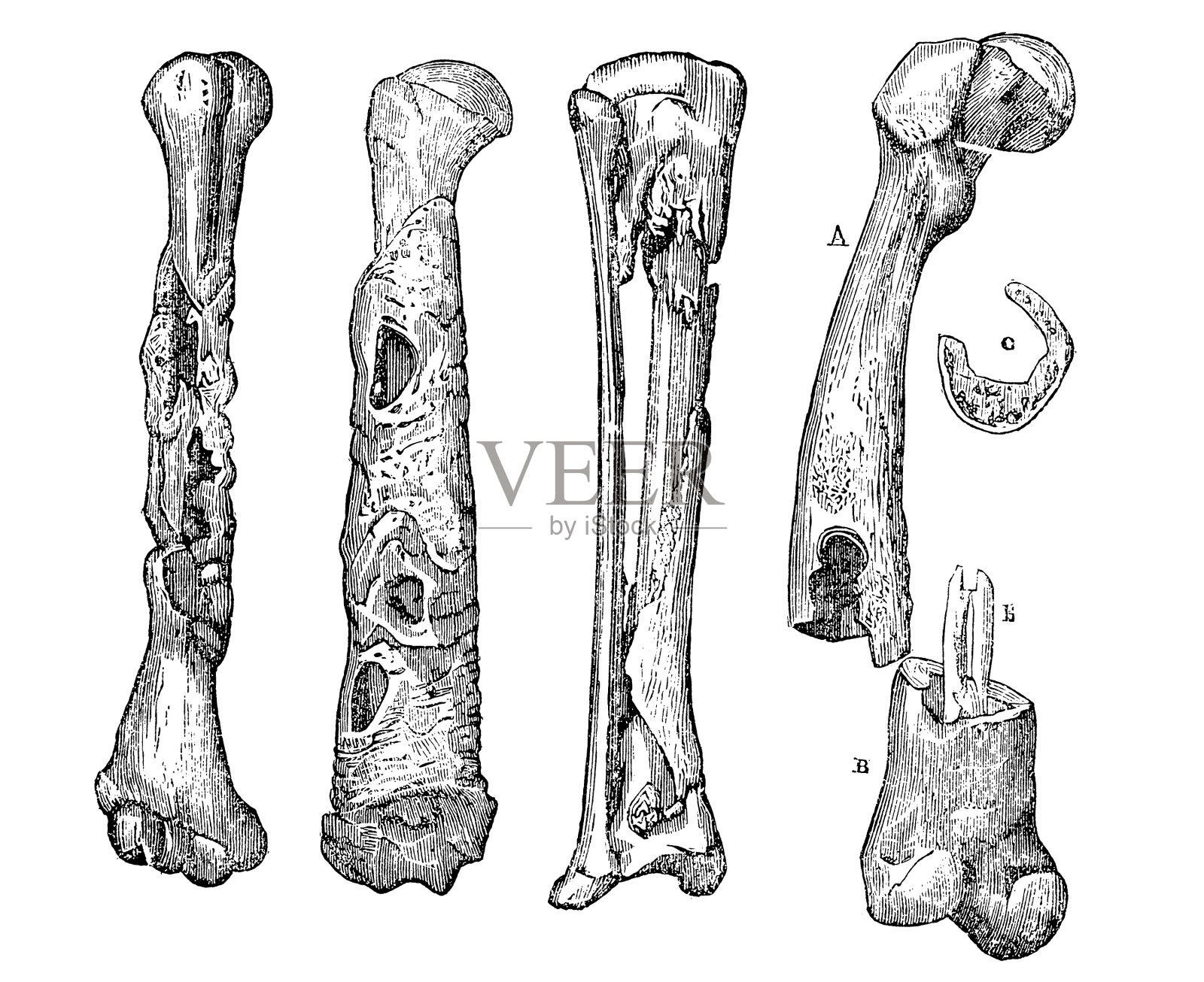 骨头坏死设计元素图片