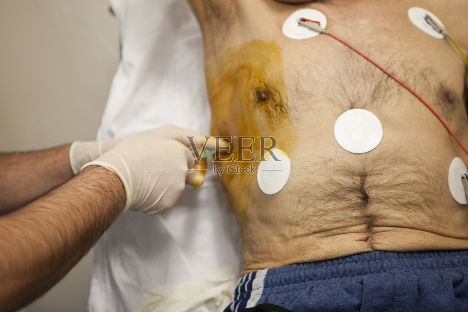 Praparin插入胸管照片摄影图片