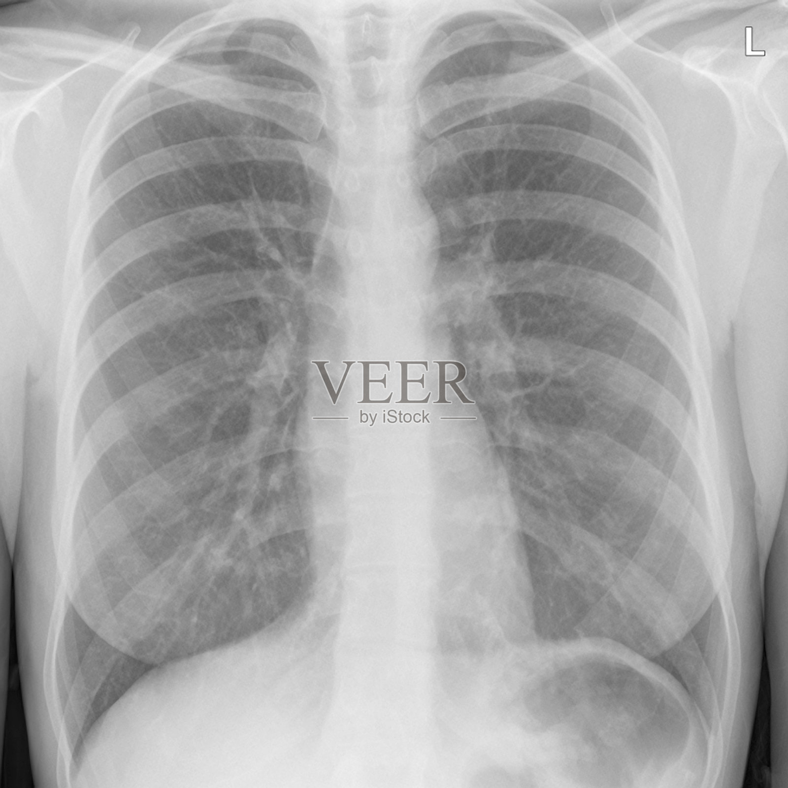 移民胸片在普查计划中没有显示肺结核照片摄影图片