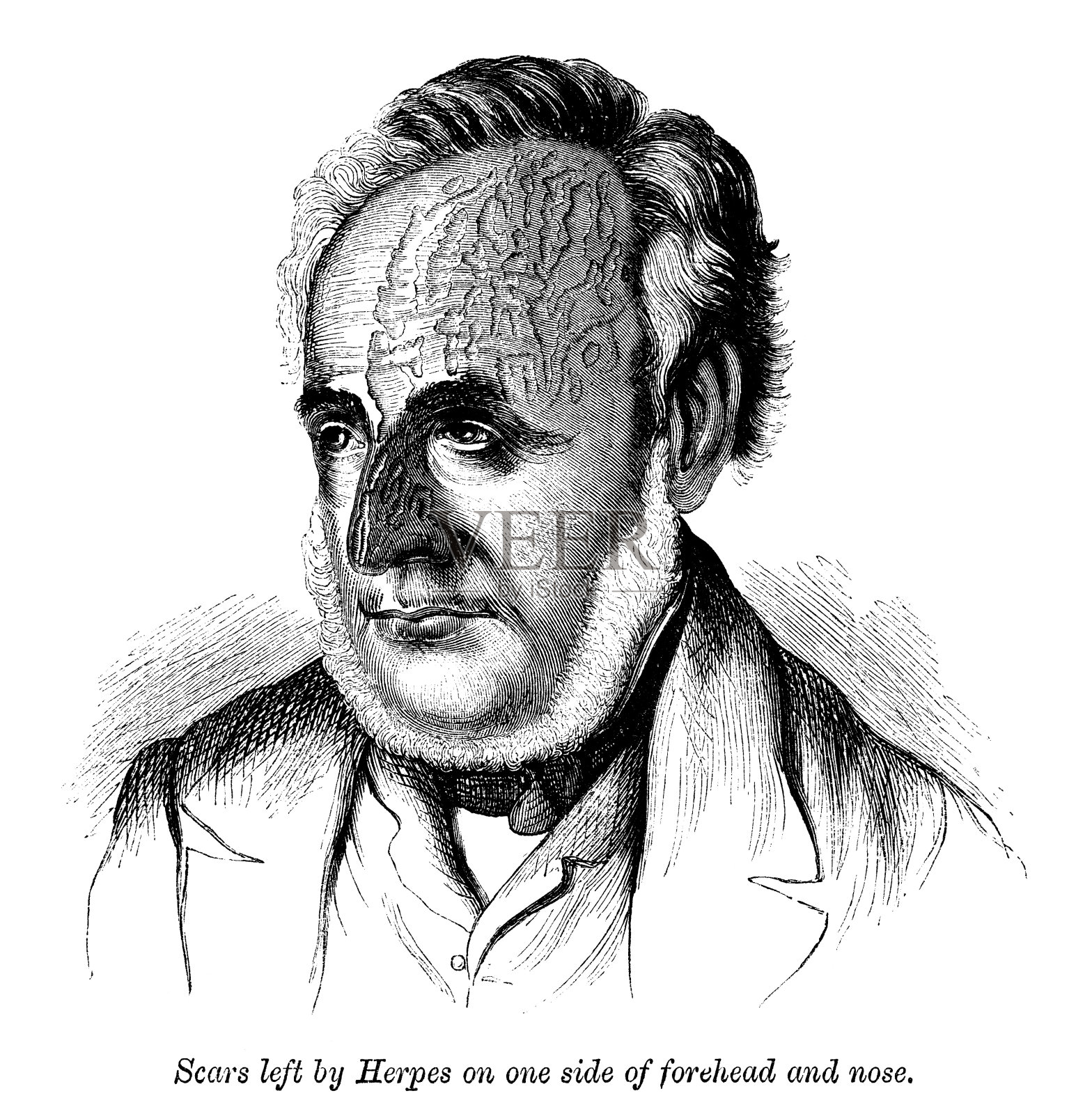 疱疹留下的疤痕(维多利亚时代的雕刻)插画图片素材