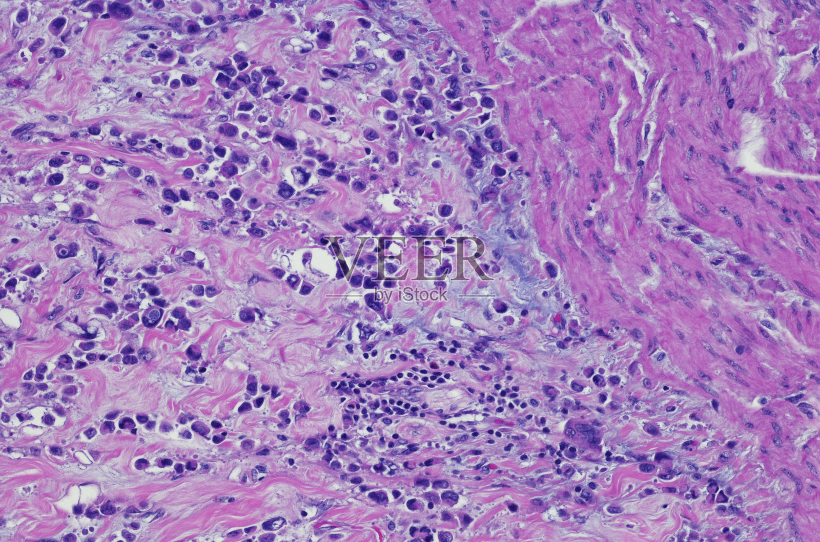 浆细胞样变异型尿路上皮癌照片摄影图片