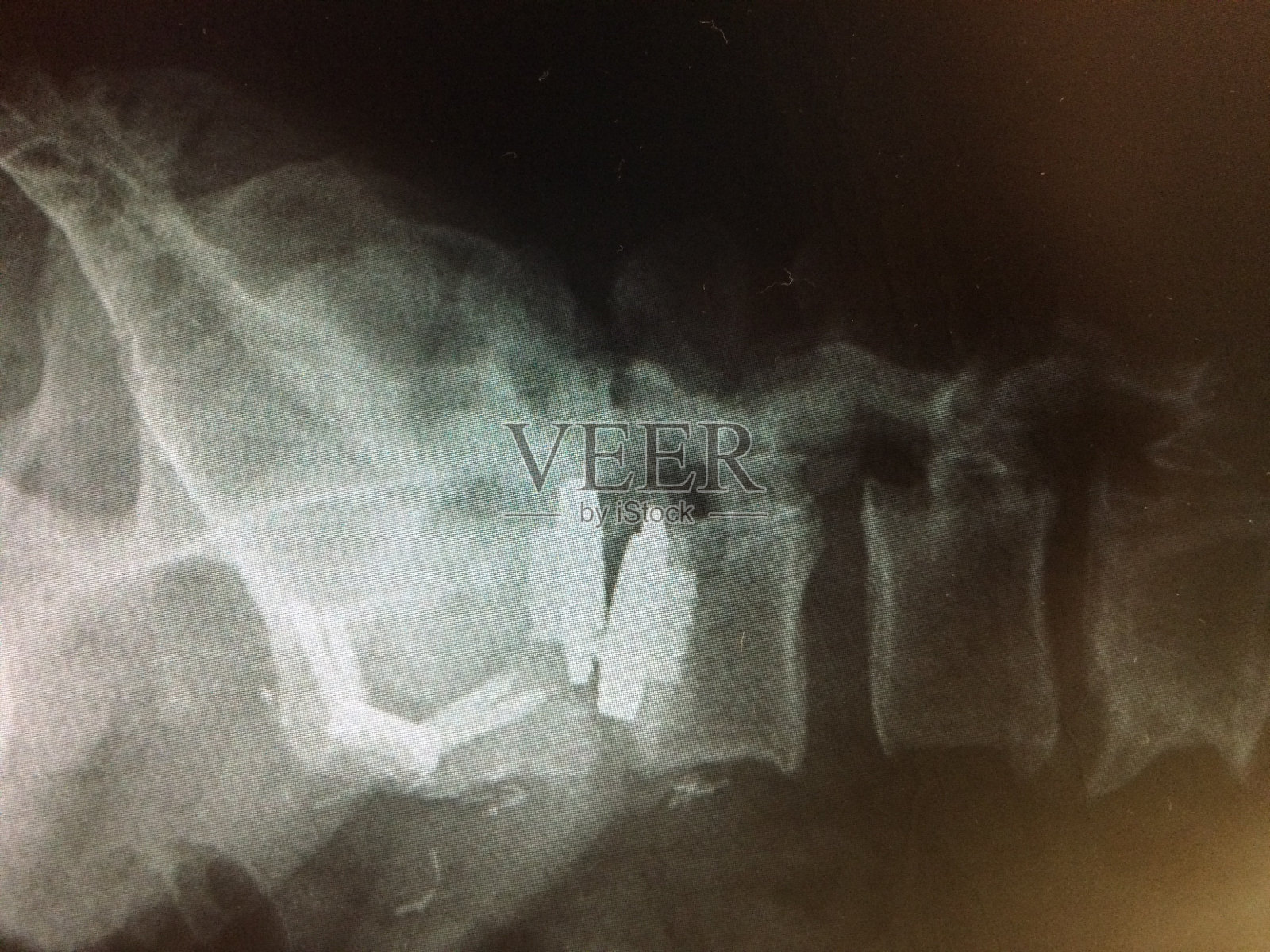 L4-5水平侧位人工椎间盘置换术失败照片摄影图片