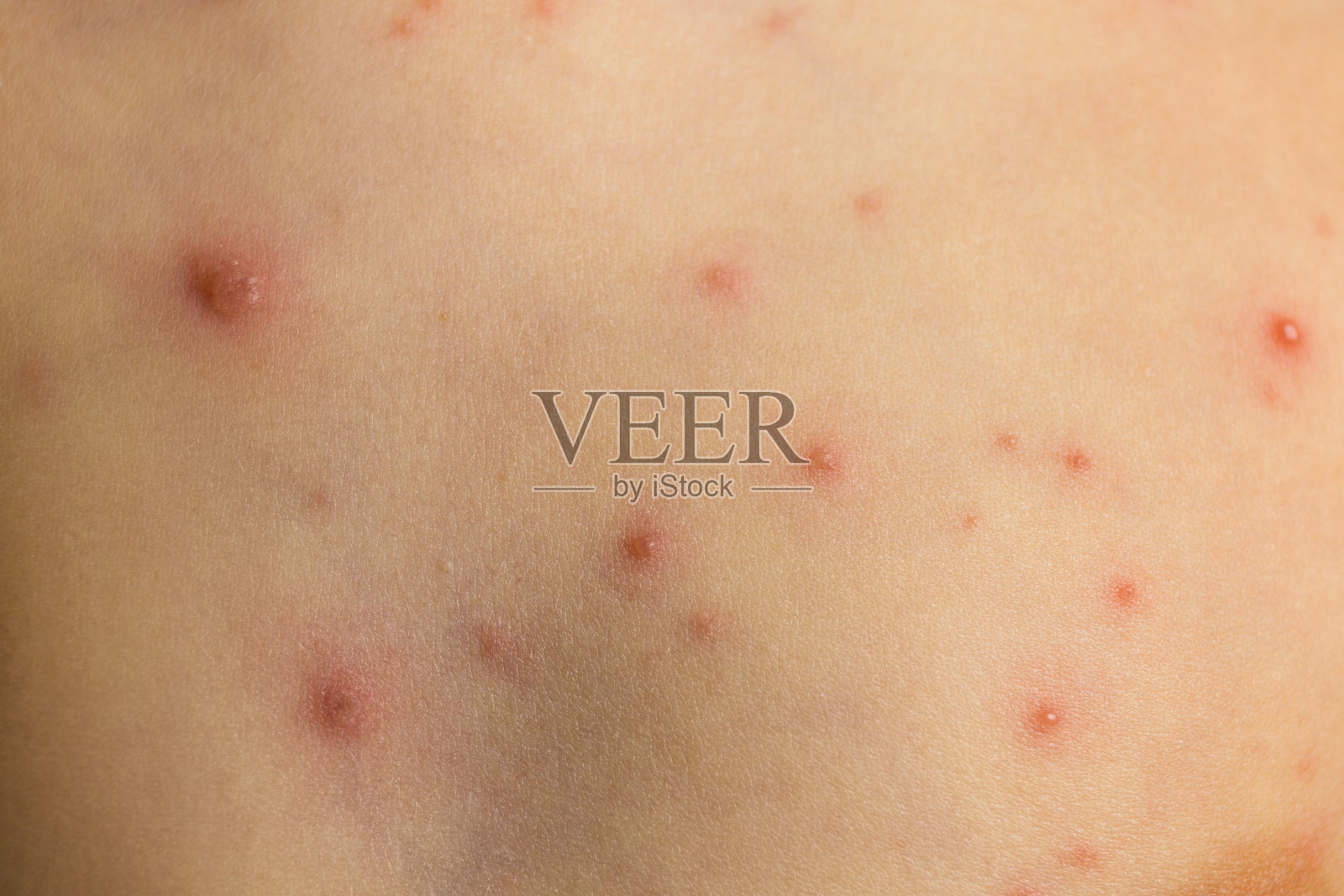 水痘肌理照片摄影图片