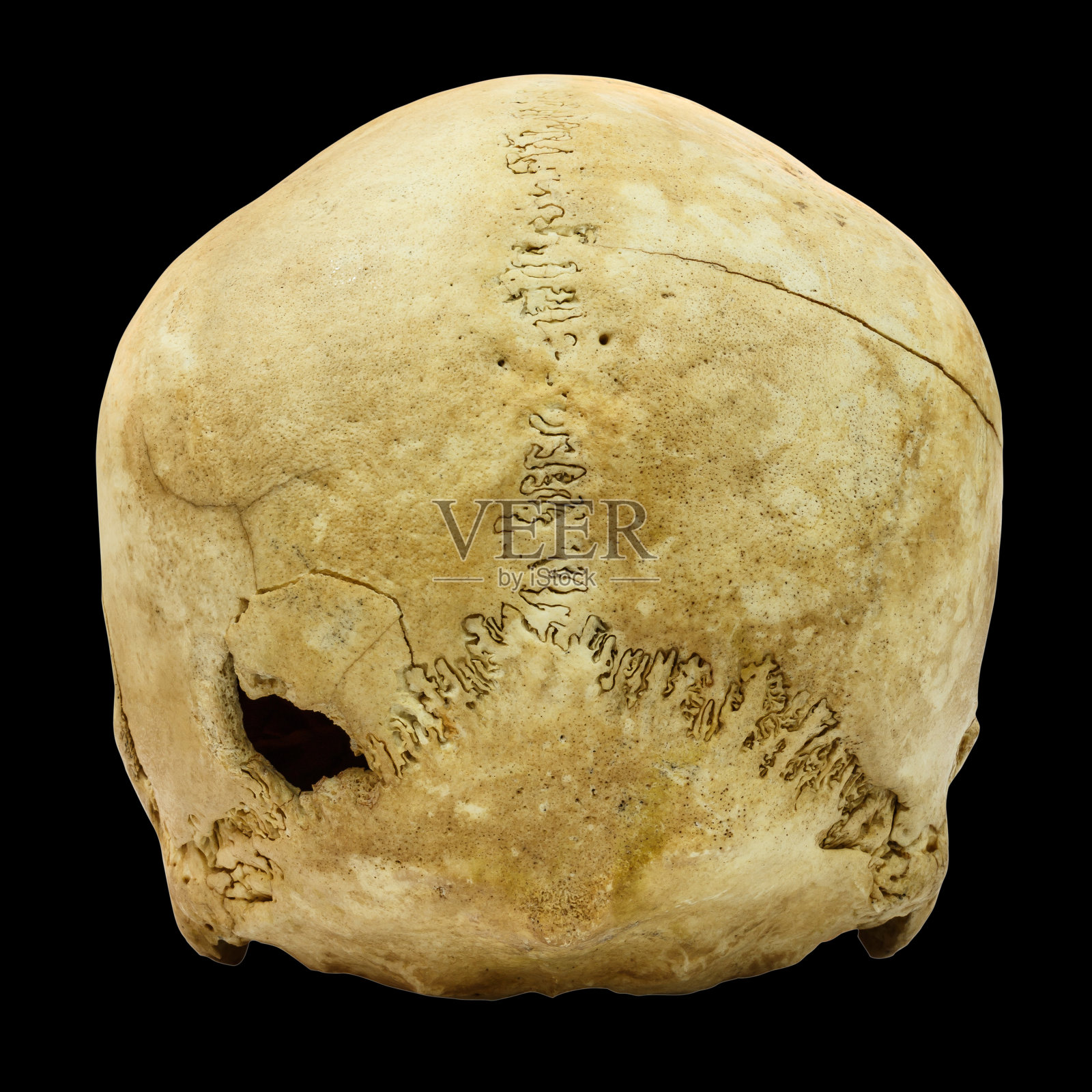 人类颅骨骨折(背部)(蒙古，亚洲)孤立背景照片摄影图片