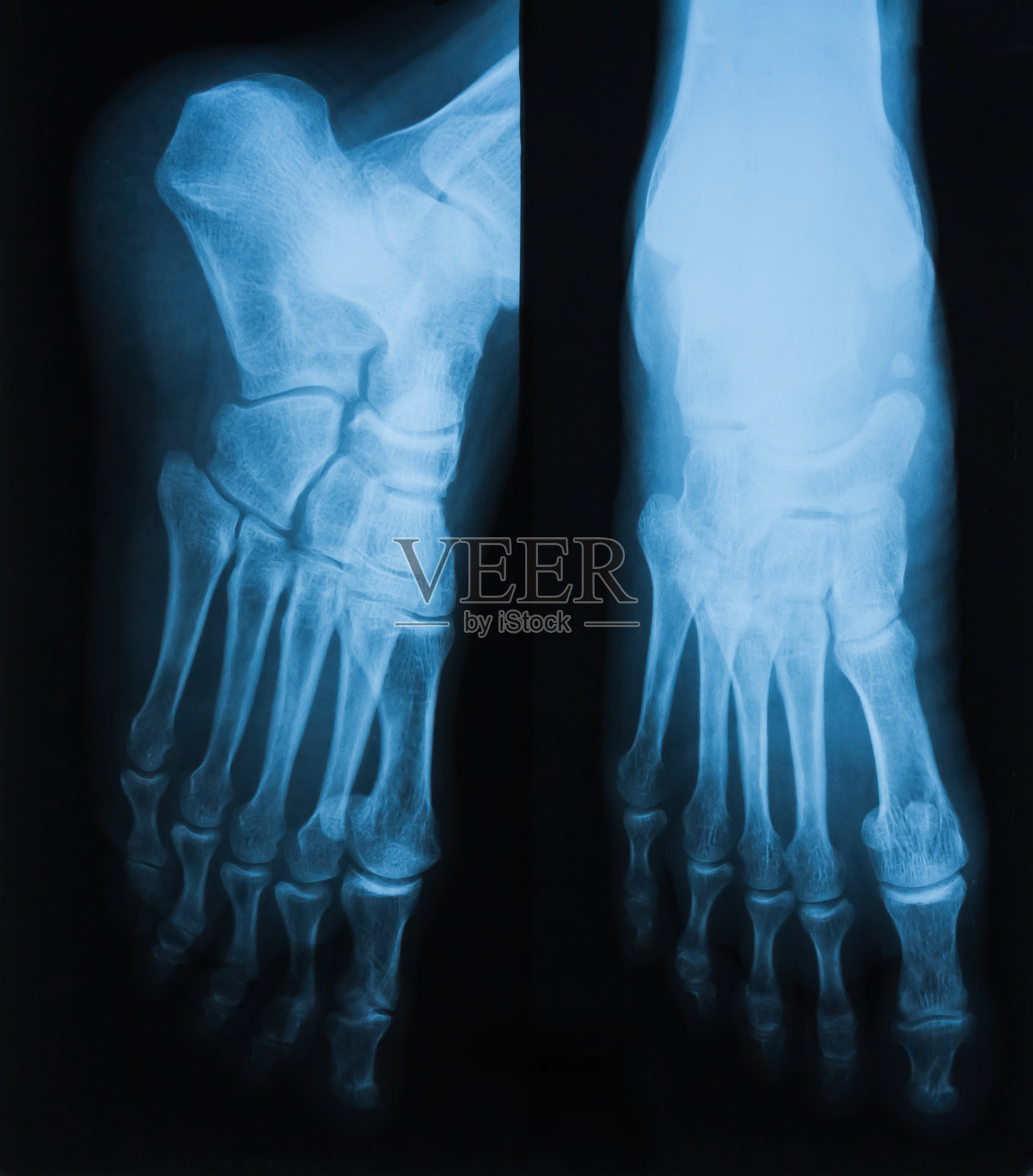 足部骨骼X光片照片摄影图片