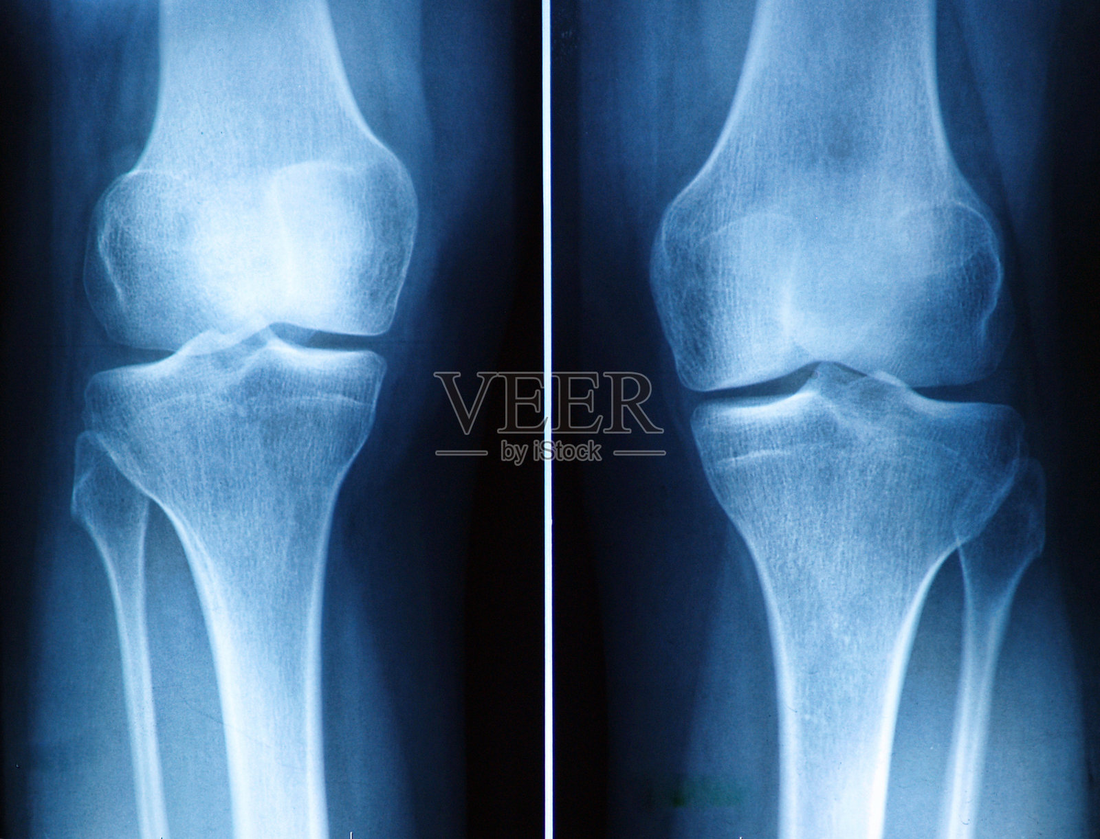 膝盖x射线照片摄影图片