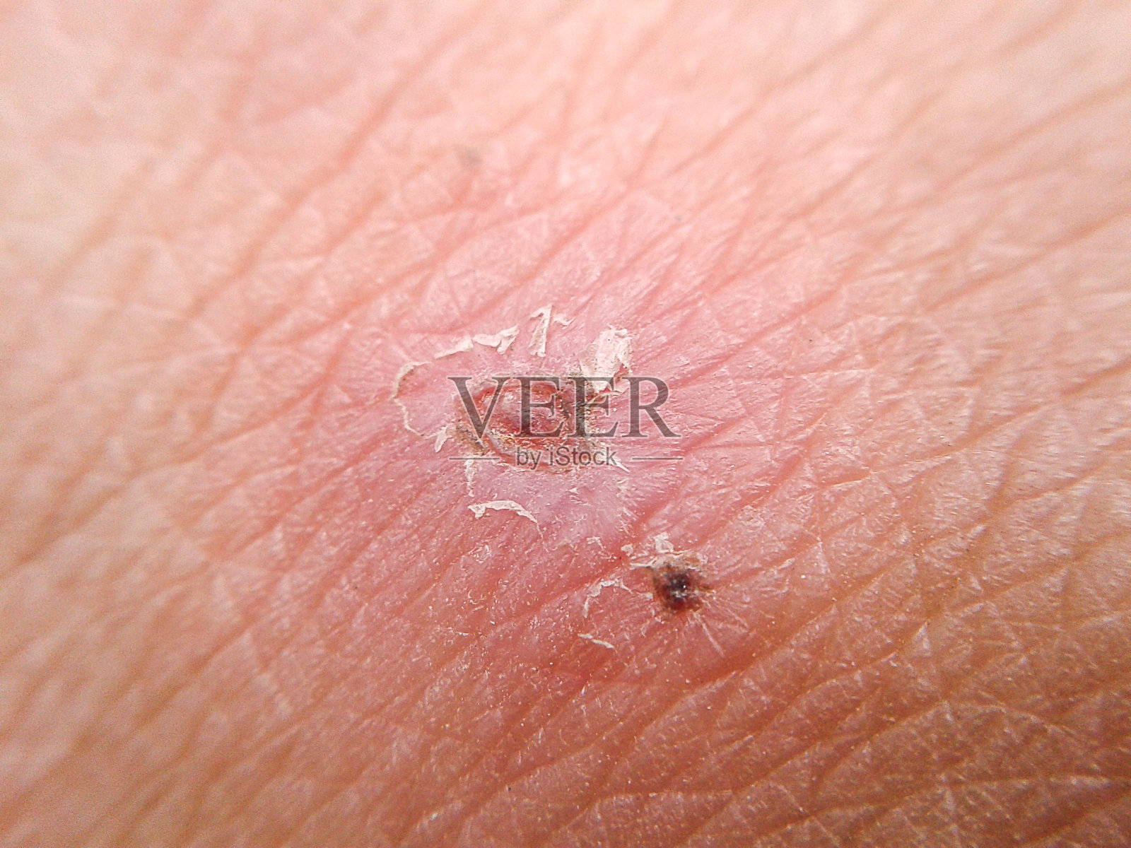 人皮肤上的疤痕照片摄影图片