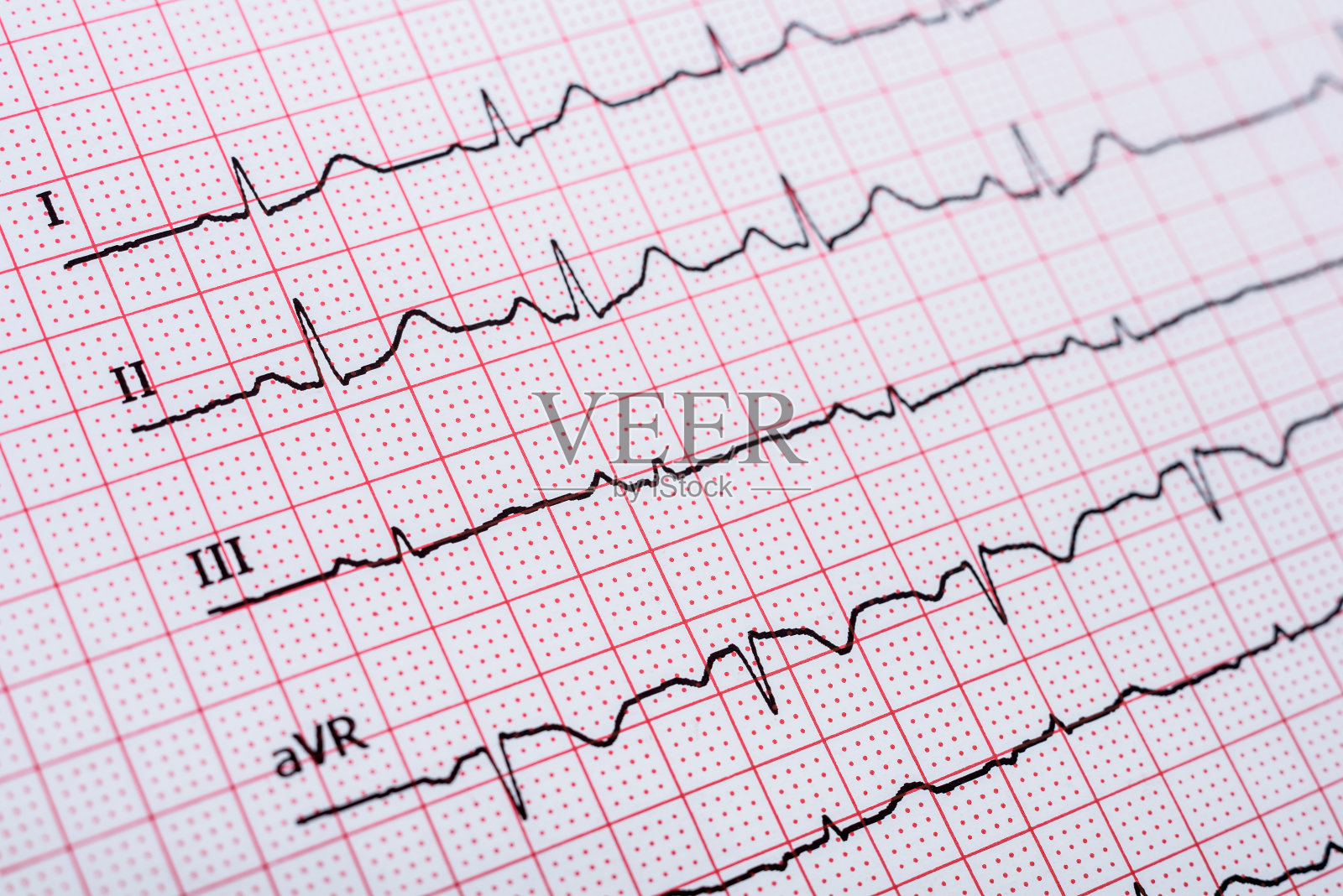 心脏正常的心电图记录纸上的窦性心律照片摄影图片