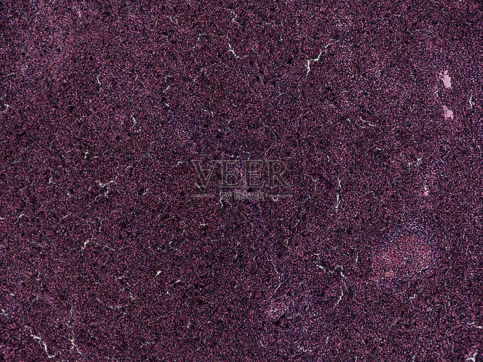 人类病理学：脾脏慢性粒细胞白血病——循环器官和造血器官的损伤照片摄影图片