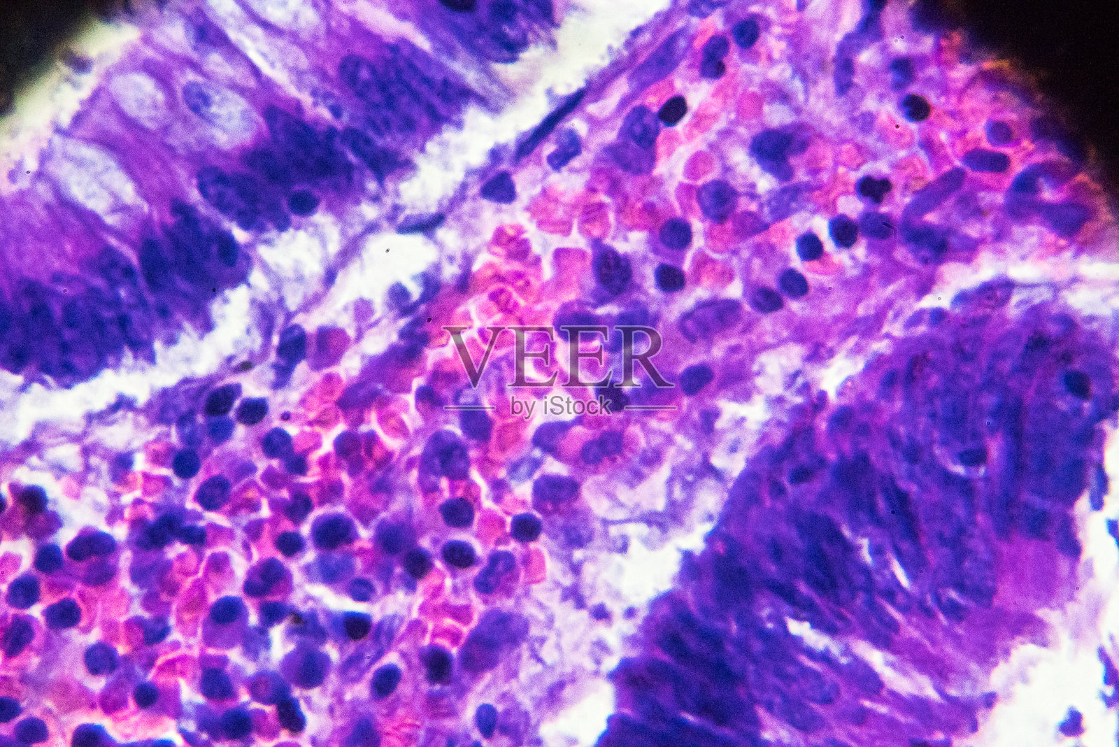 显微镜下的大肠癌(差异很大，管状腺癌)照片摄影图片