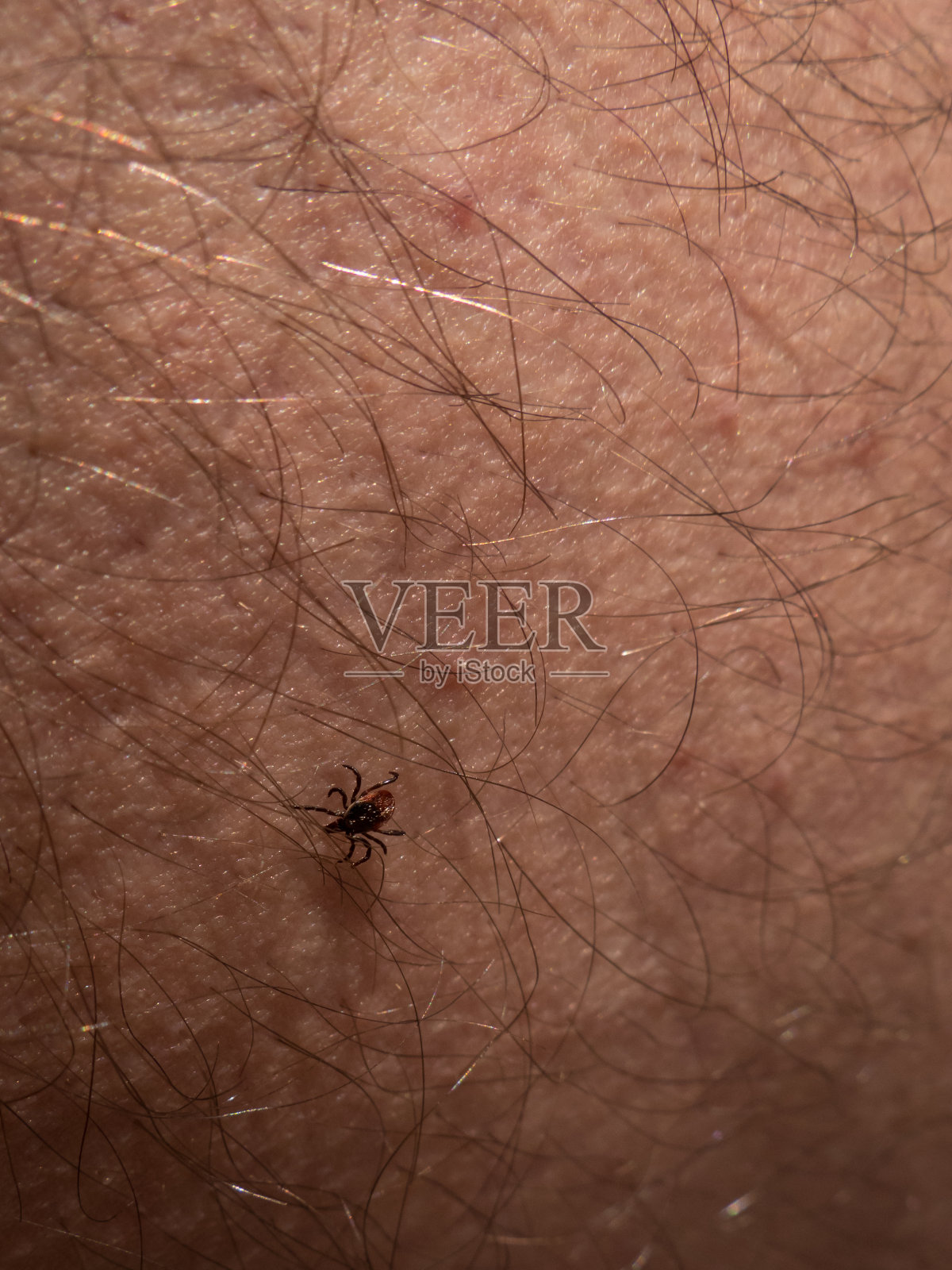 人皮肤上的蜱虫照片摄影图片