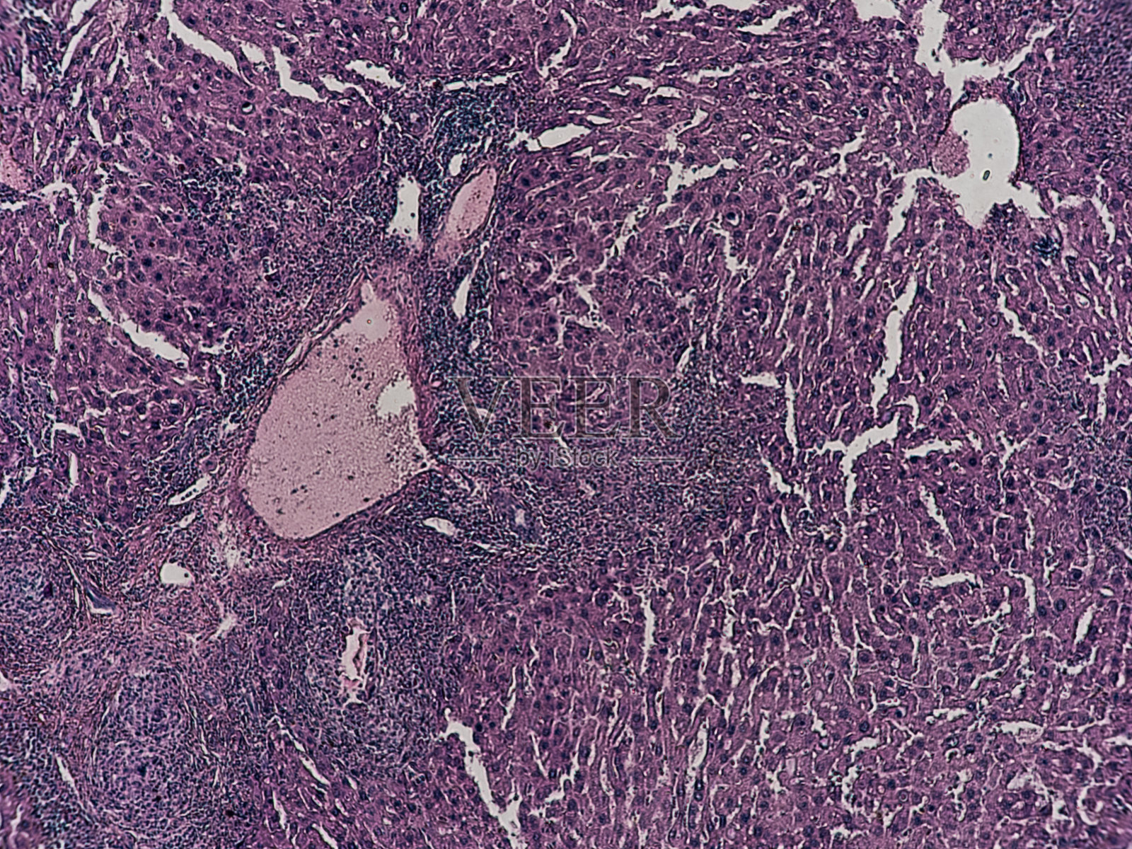 人体病理学：含血铁黄素和巨细胞的异物肉芽肿 - 显微镜下细胞和组织的异常改变照片摄影图片