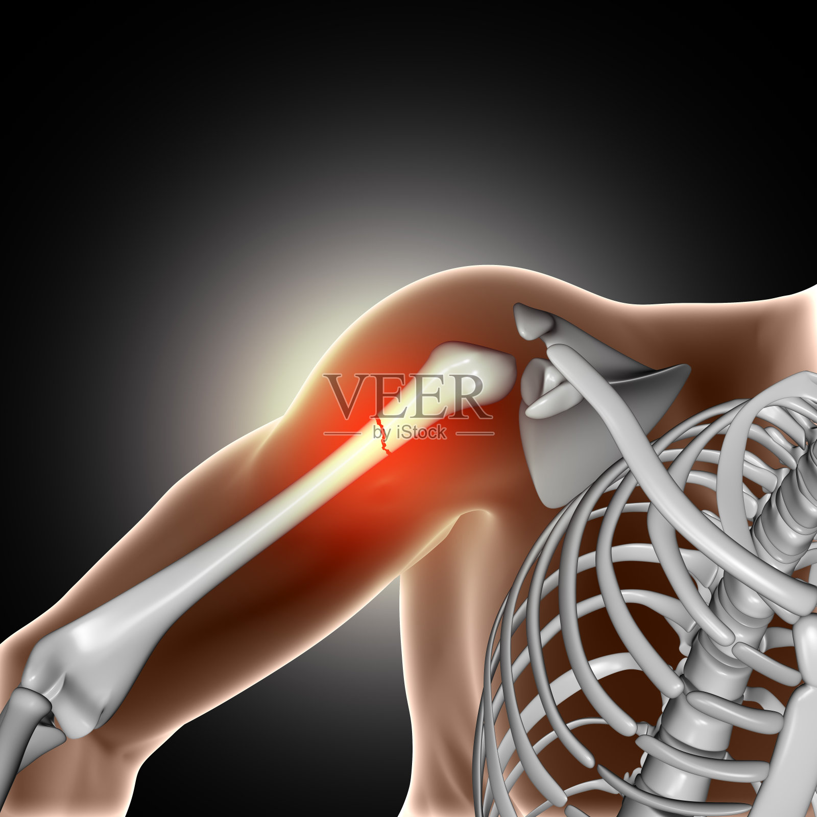 手臂骨折的3D医学图像照片摄影图片