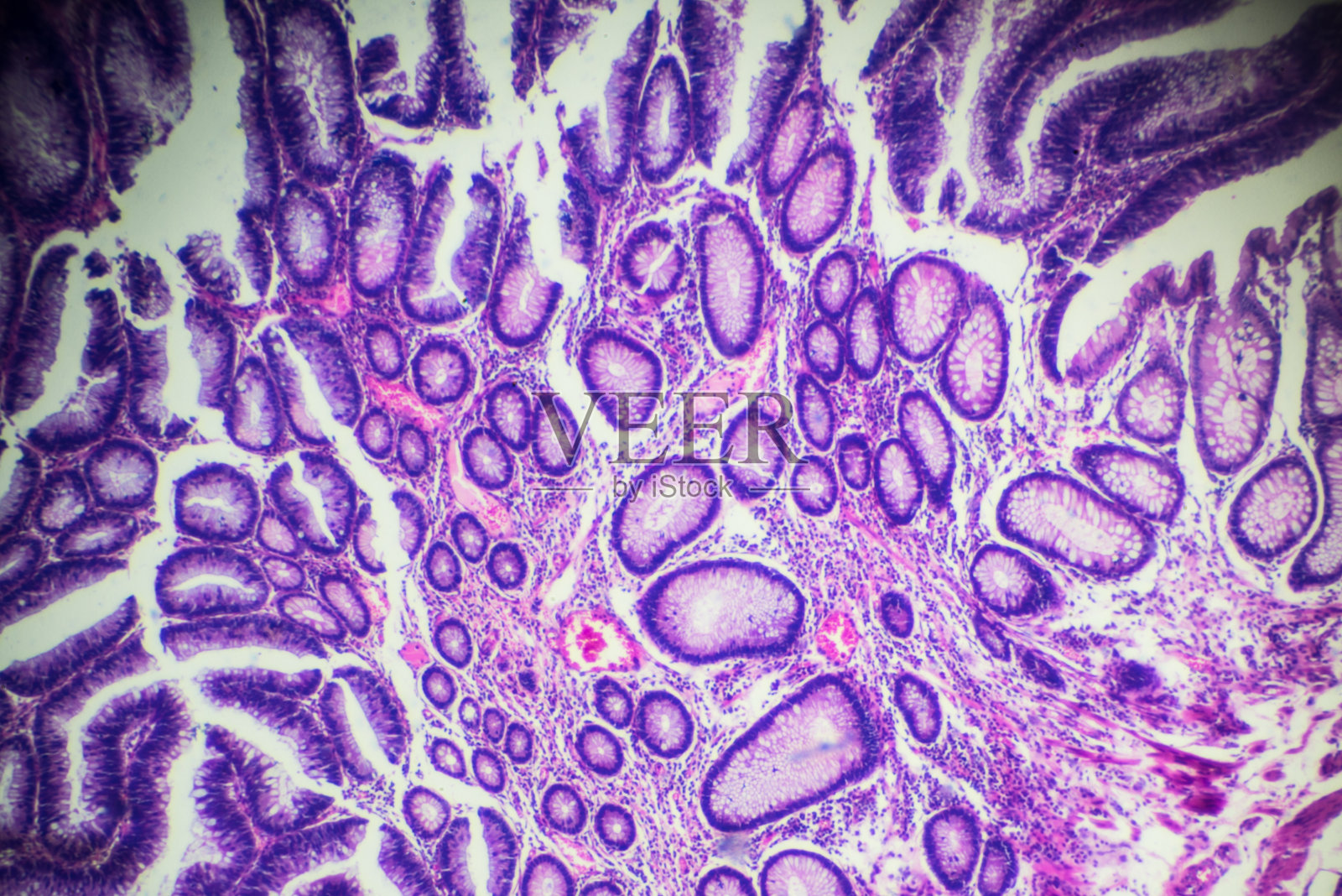 肠腺瘤病人体病理标本的显微镜观察照片摄影图片